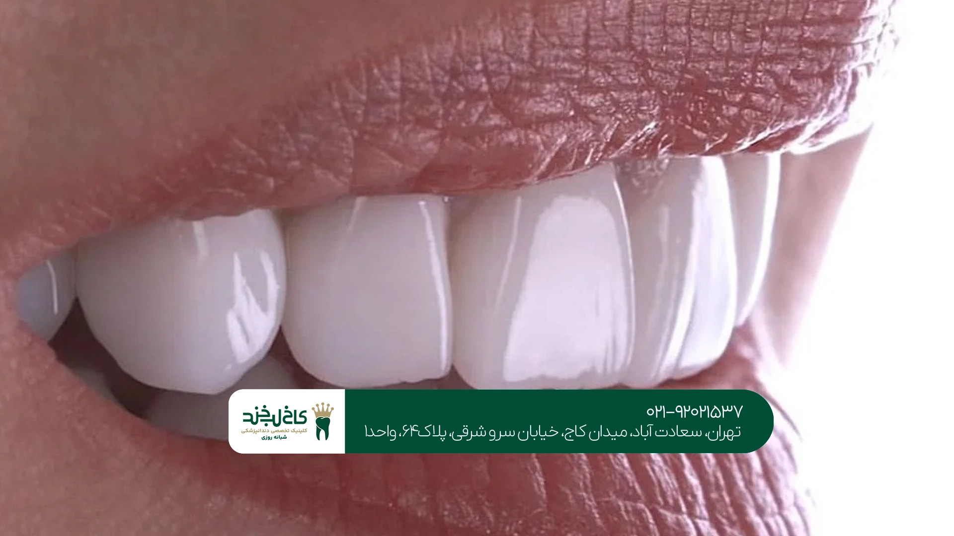 کلینیک کامپوزیت و لمینت سعادت آباد