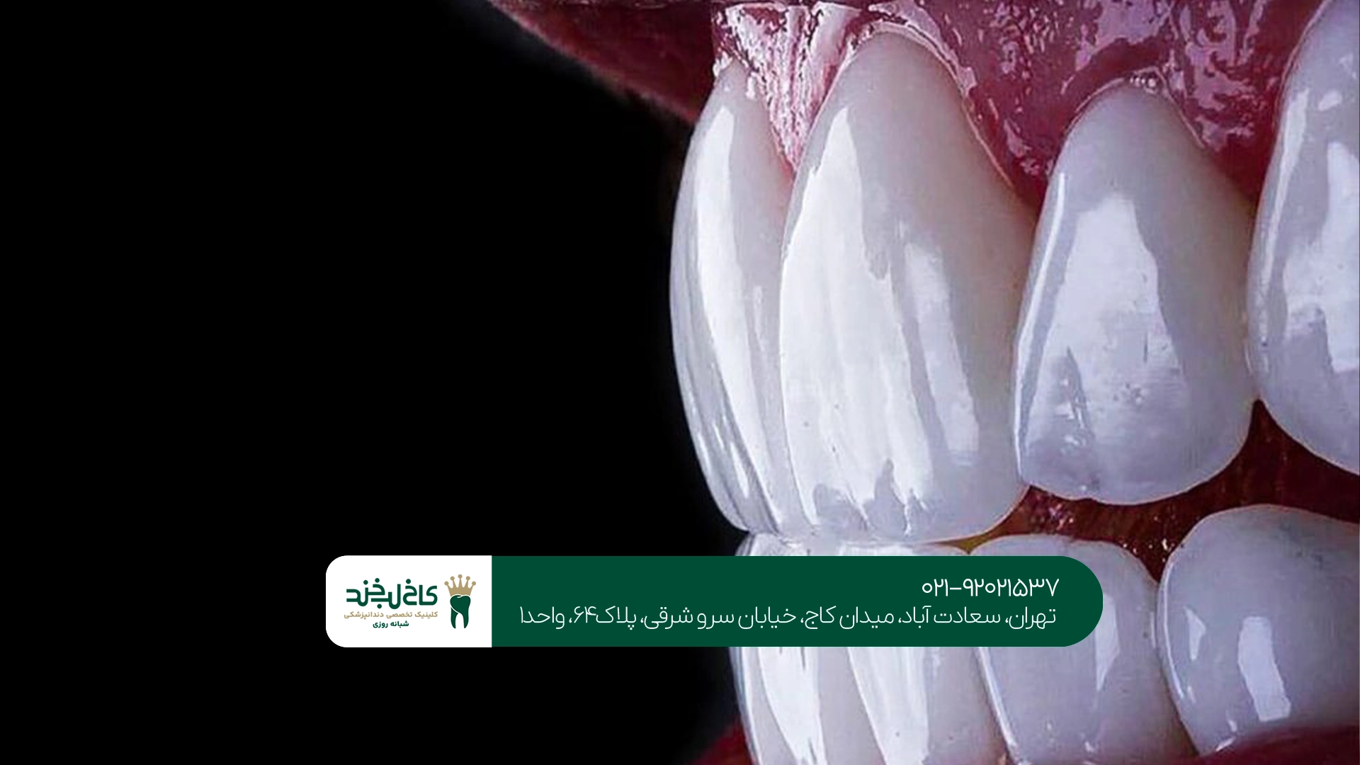 کامپوزیت دندان سعادت آباد