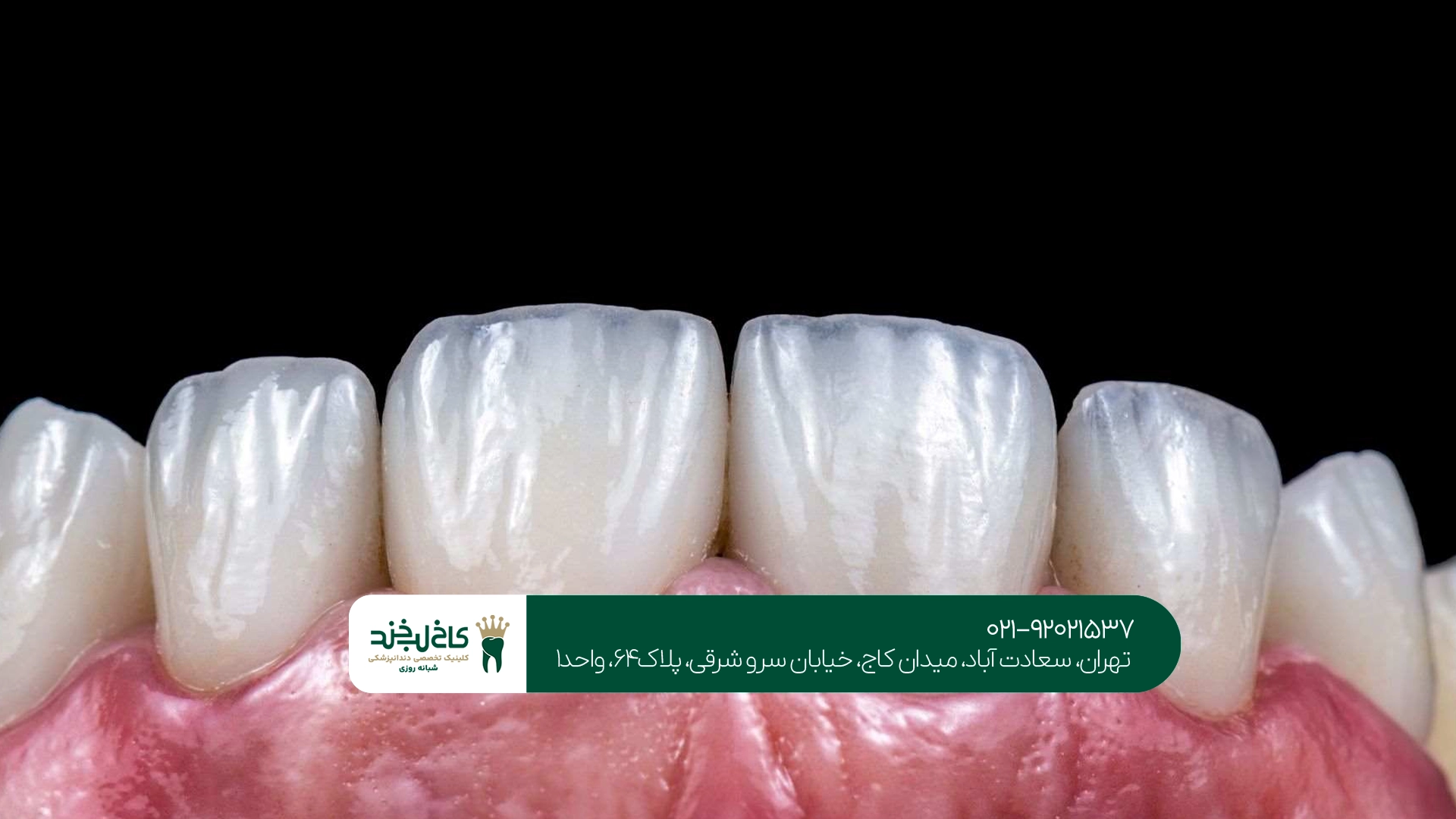 مراحل انجام کامپوزیت و لمینت دندان در سعادت آباد