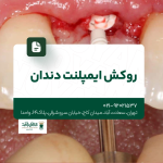 روکش ایمپلنت دندان