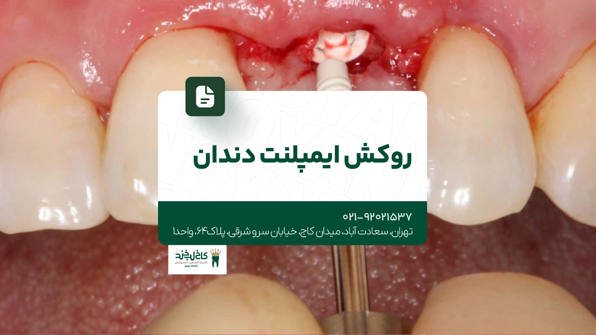 روکش ایمپلنت دندان روکش ایمپلنت دندان
