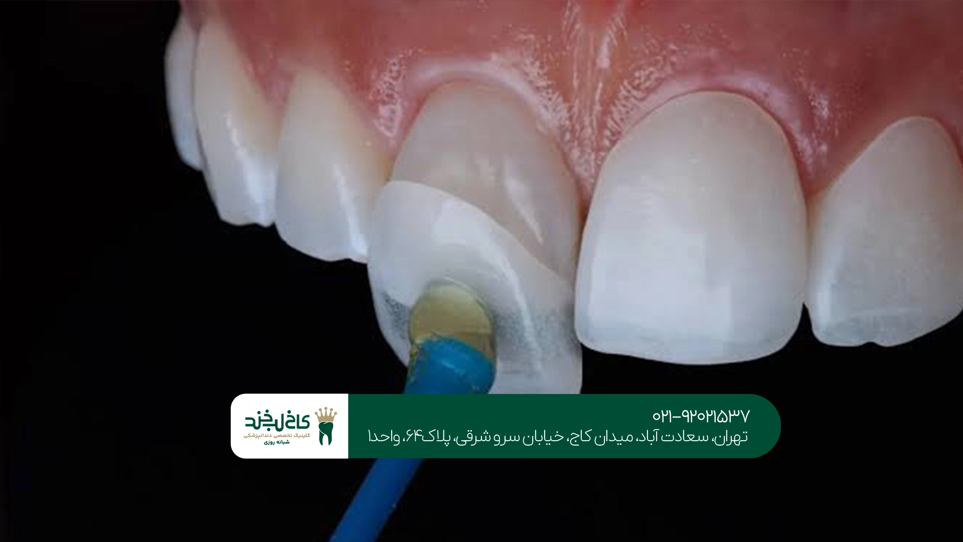 مراقبتهای بعد از روکش دندان سرامیکی
