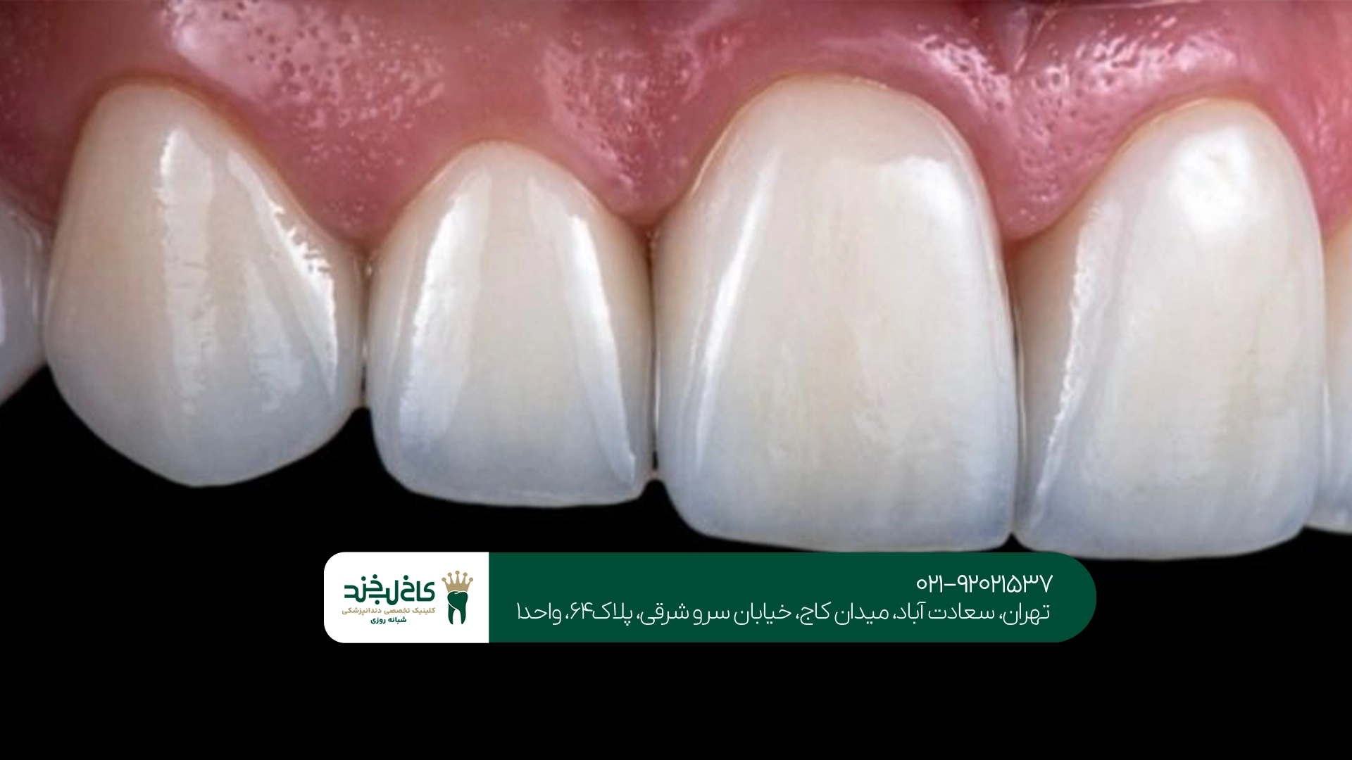 روکش دندان سرامیکی برای چه افرادی مناسب است؟