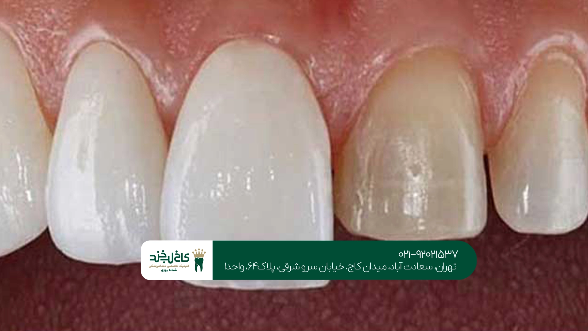 بهترین مرکز روکش زیرکونیا بهترین مرکز روکش زیرکونیا