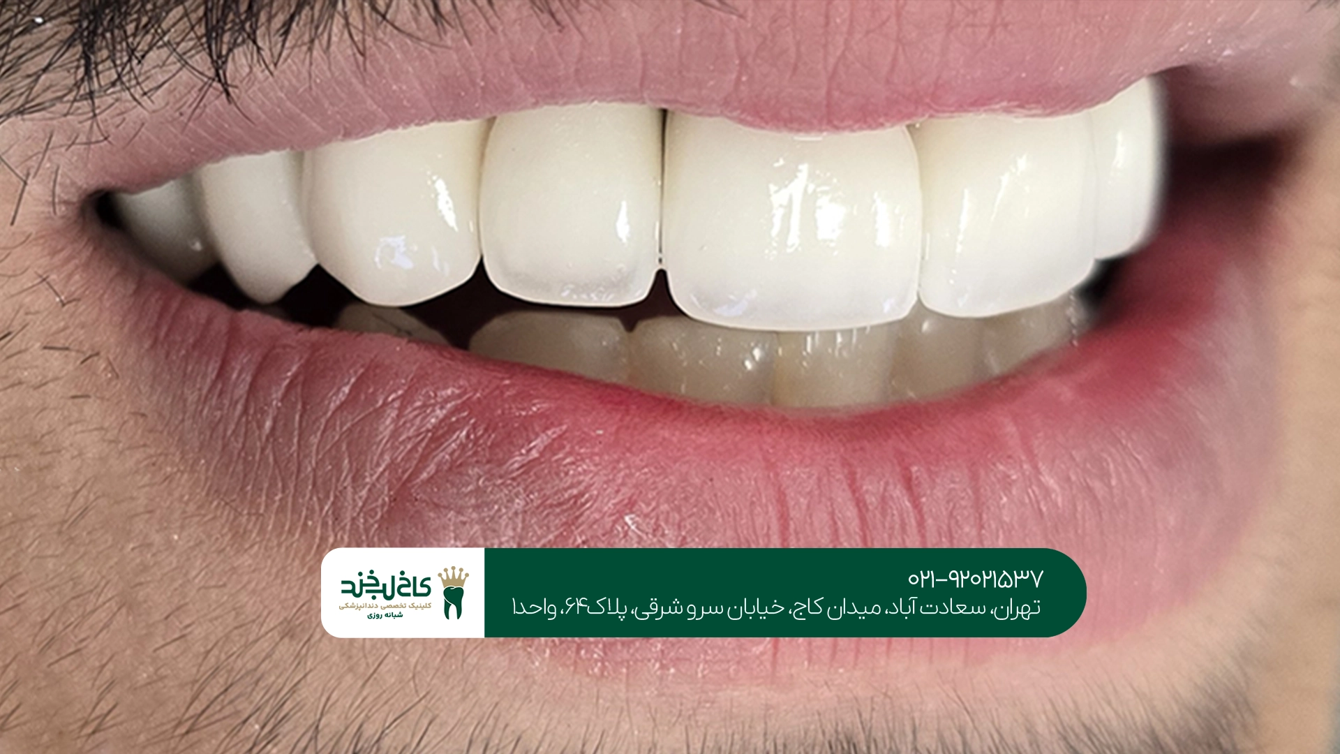 قیمت روکش زیرکونیا دندان قیمت روکش زیرکونیا دندان