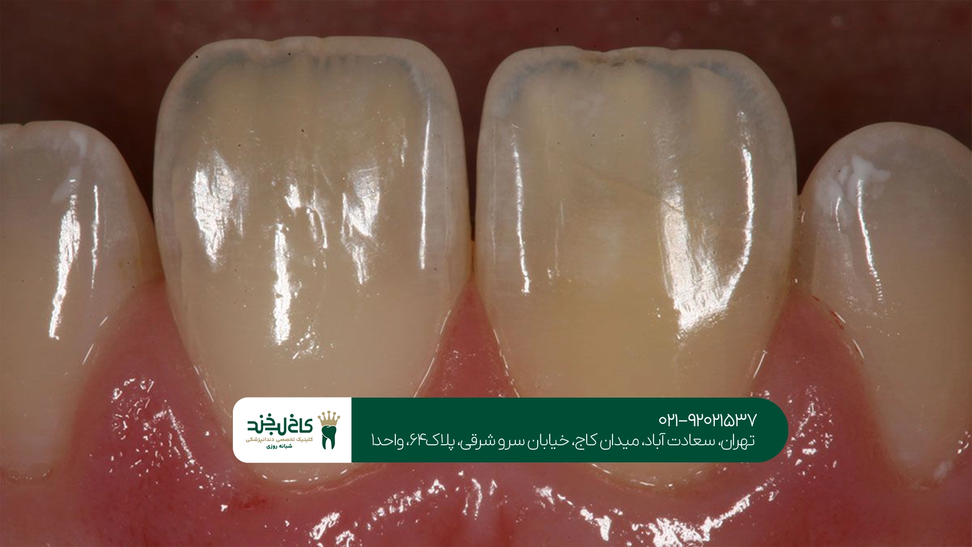 روکش زیرکونیا دندان روکش زیرکونیا دندان