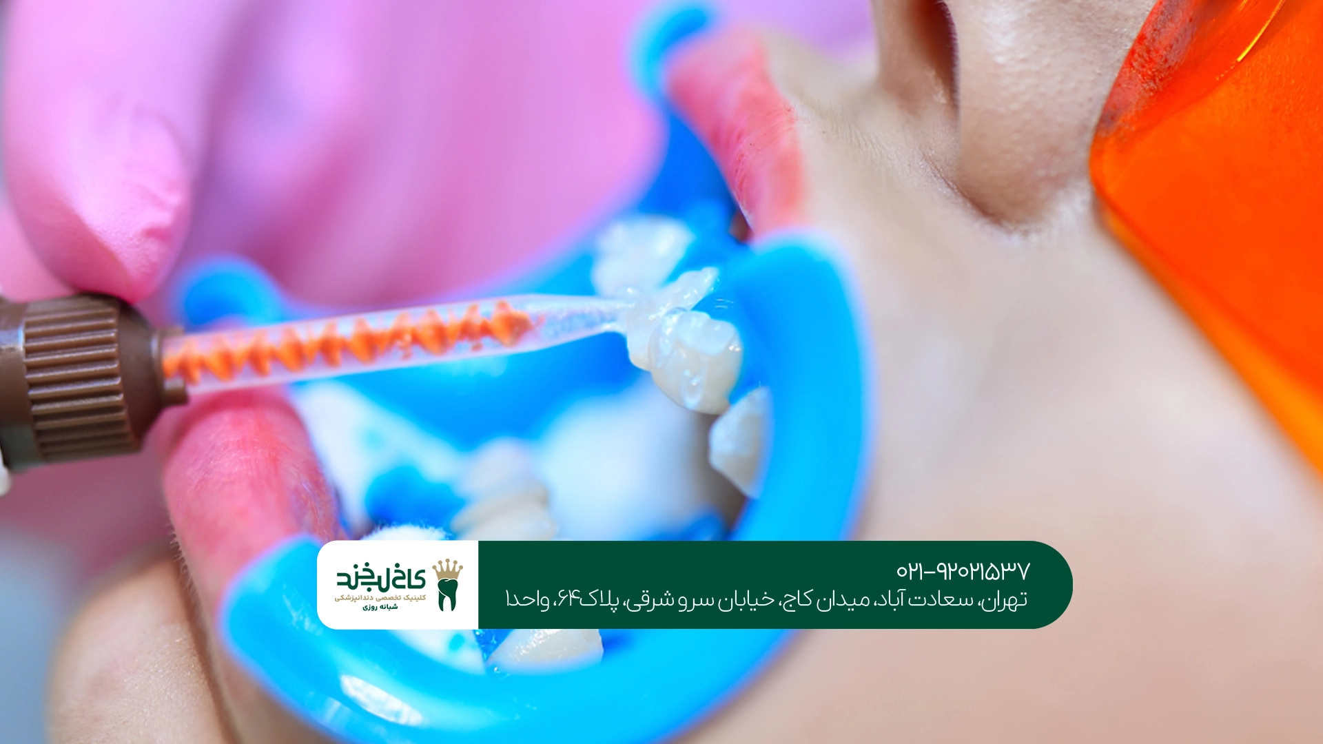 مرکز تخصصی بلیچینگ دندان تهران