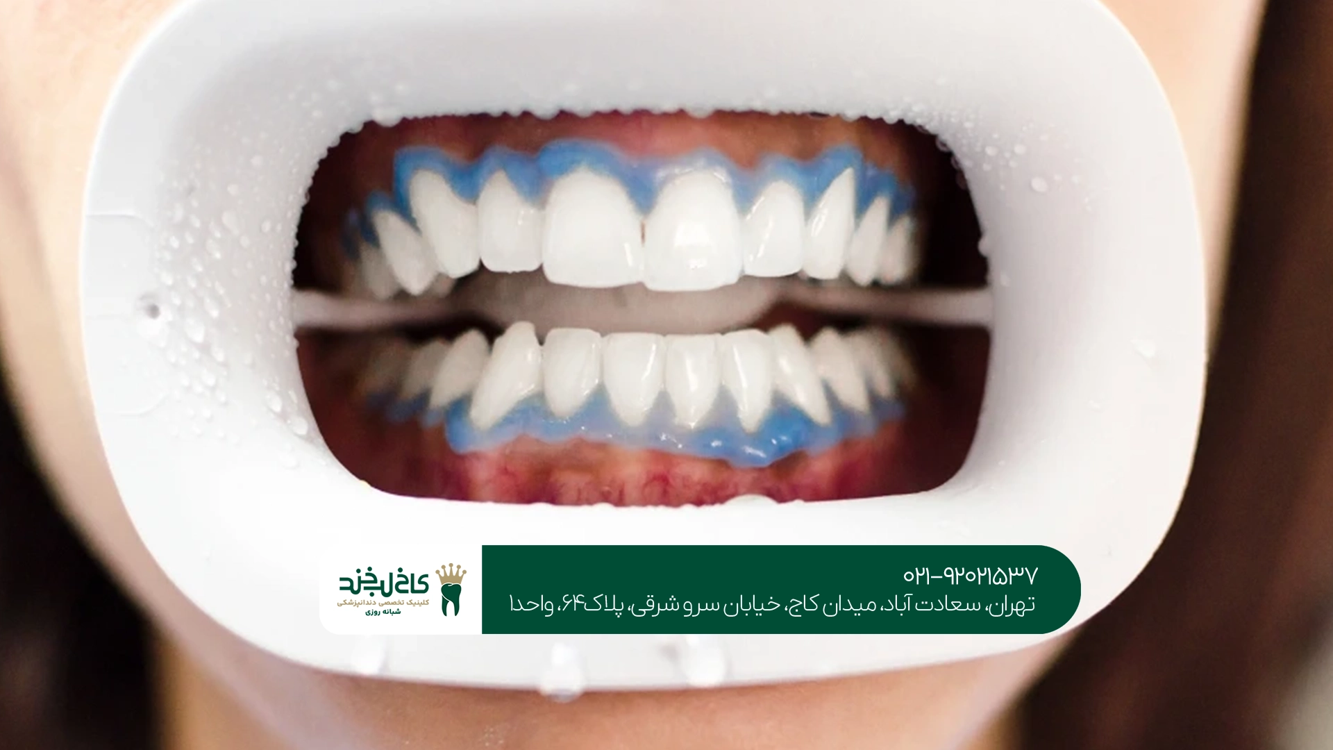 سفید کردن دندان در کلینیک دندانپزشکی