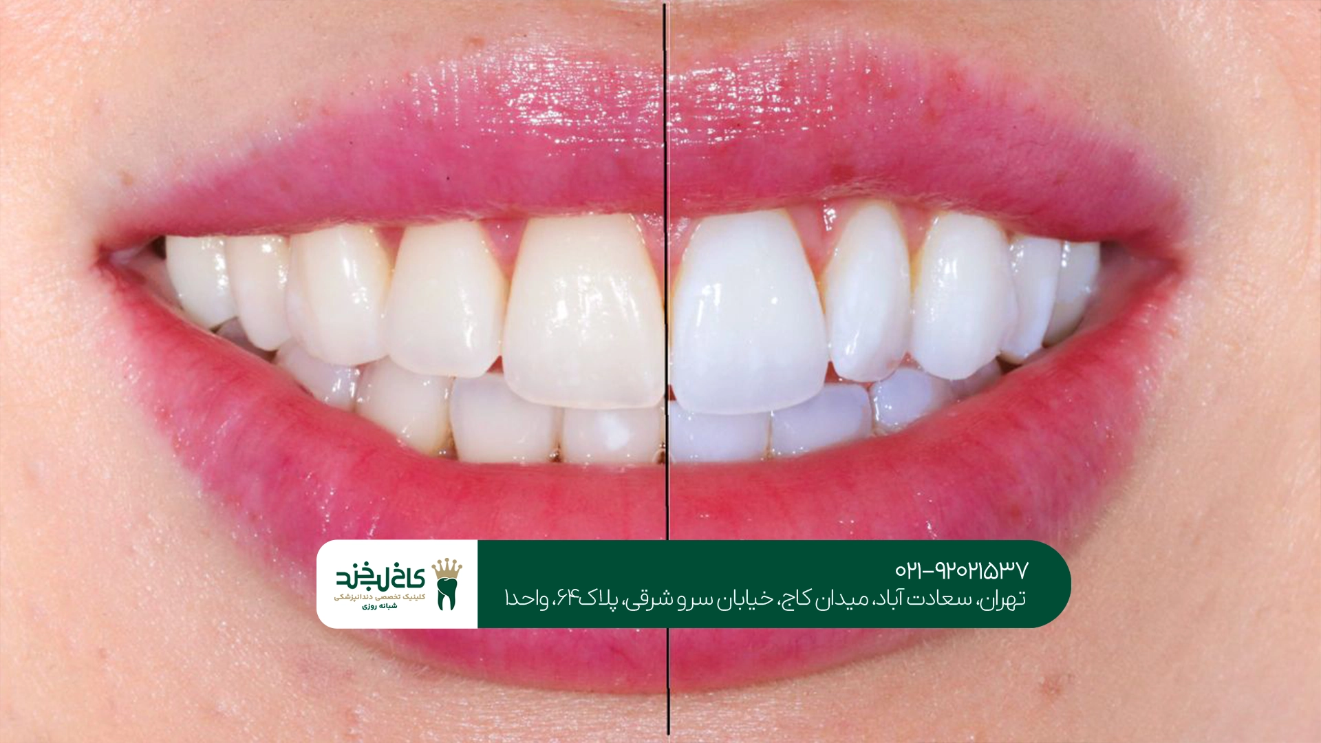 تفاوت بلیچینگ دندان در خانه و کلینیک دندانپزشکی