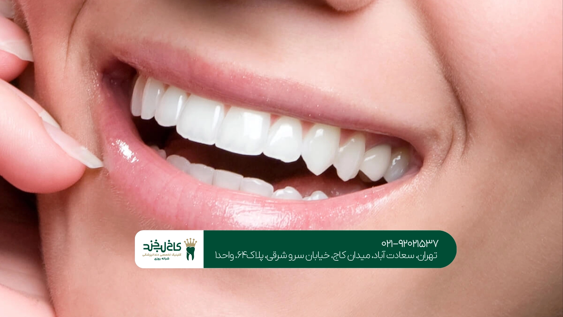ماندگاری سفید کردن دندان در کلینیک چقدر است؟