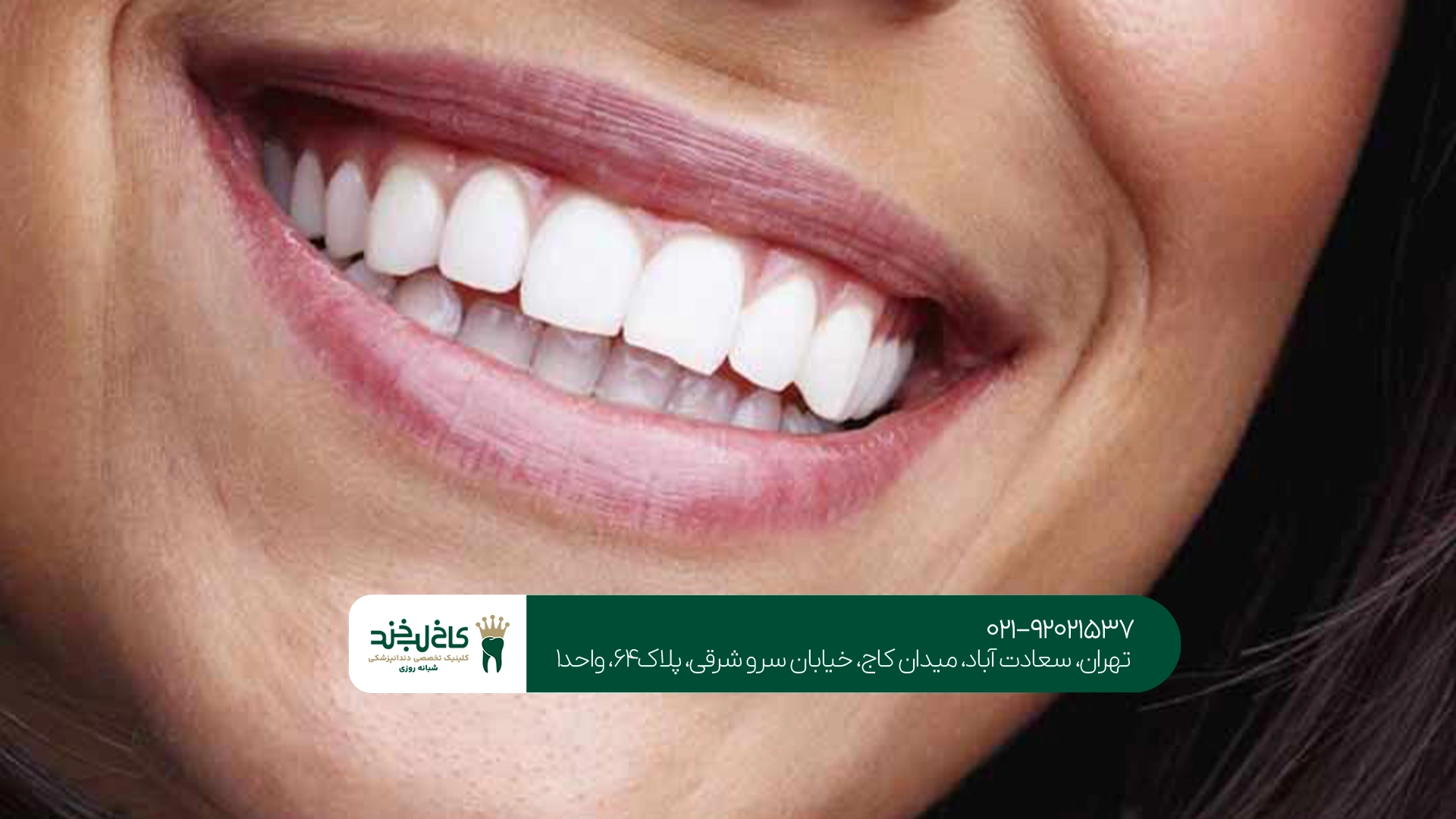 چه کسانی کاندیدای مناسب سفید کردن دندان در کلینیک هستند؟