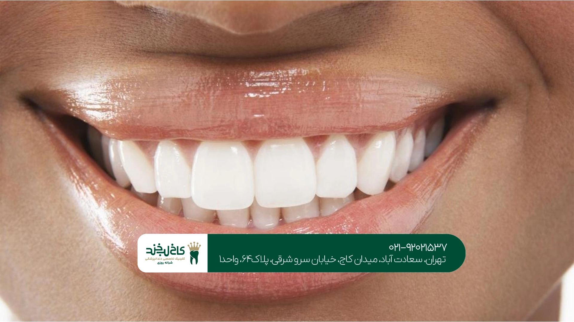 مرکز سفید کردن دندان