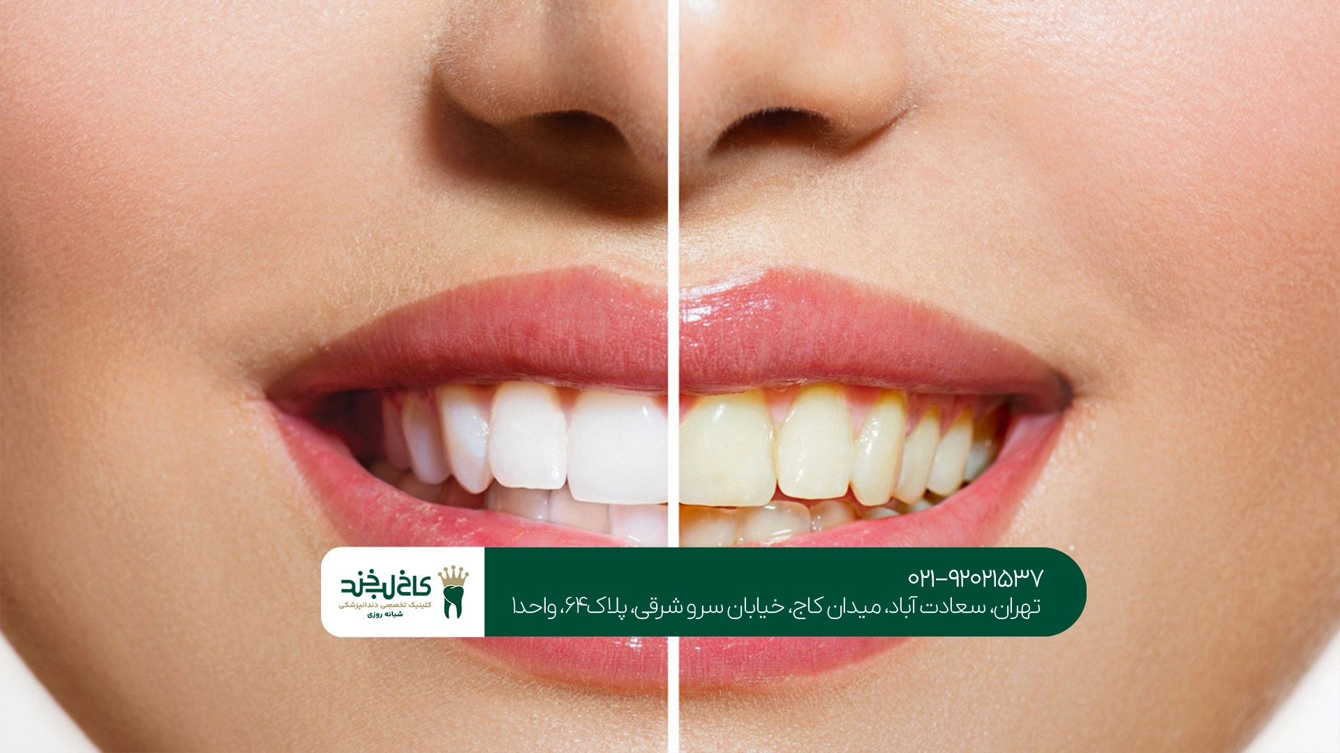 سفید کردن دندان زرد در تهران سفید کردن دندان زرد در تهران