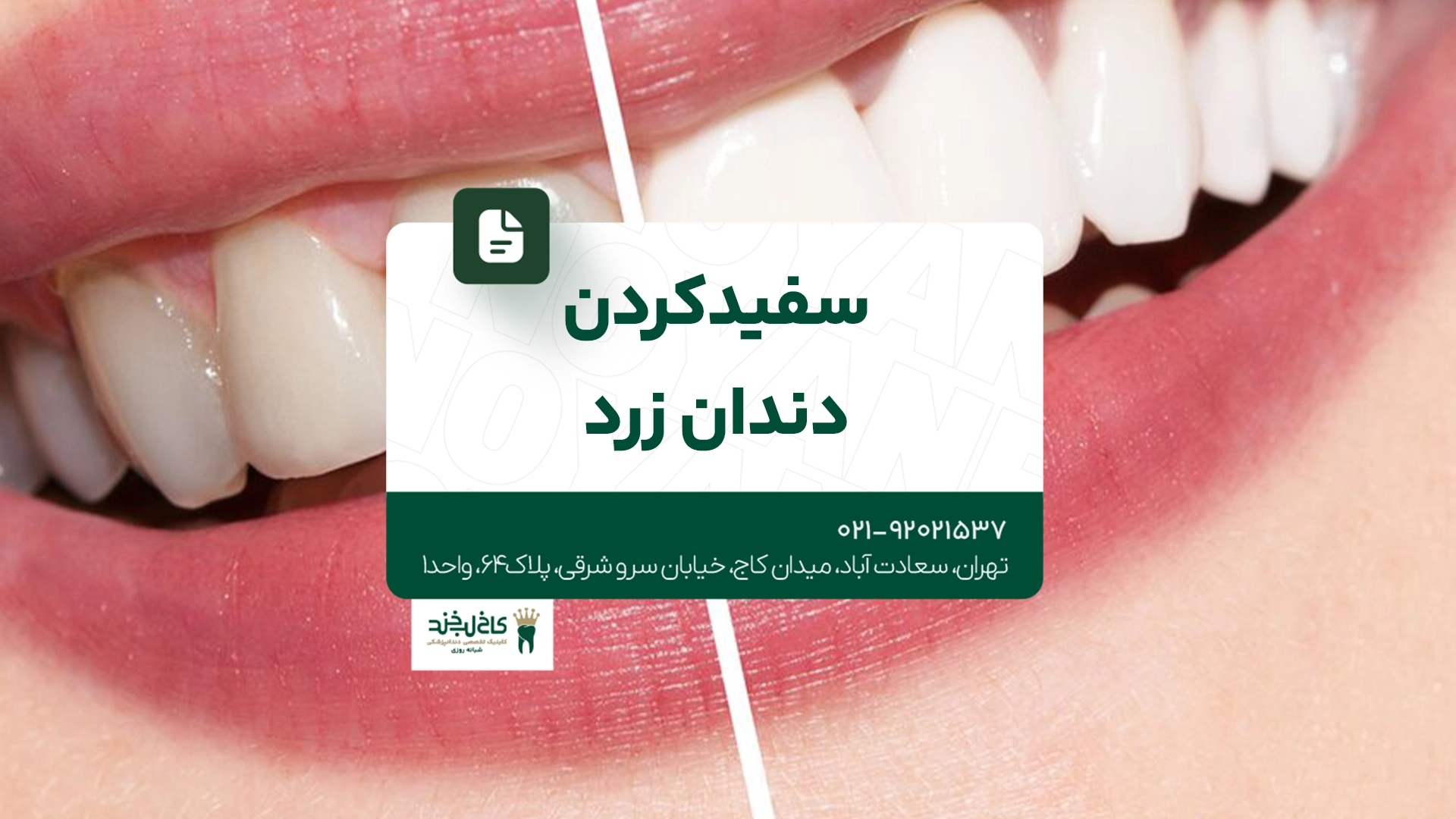 سفید کردن دندان زرد سفید کردن دندان زرد