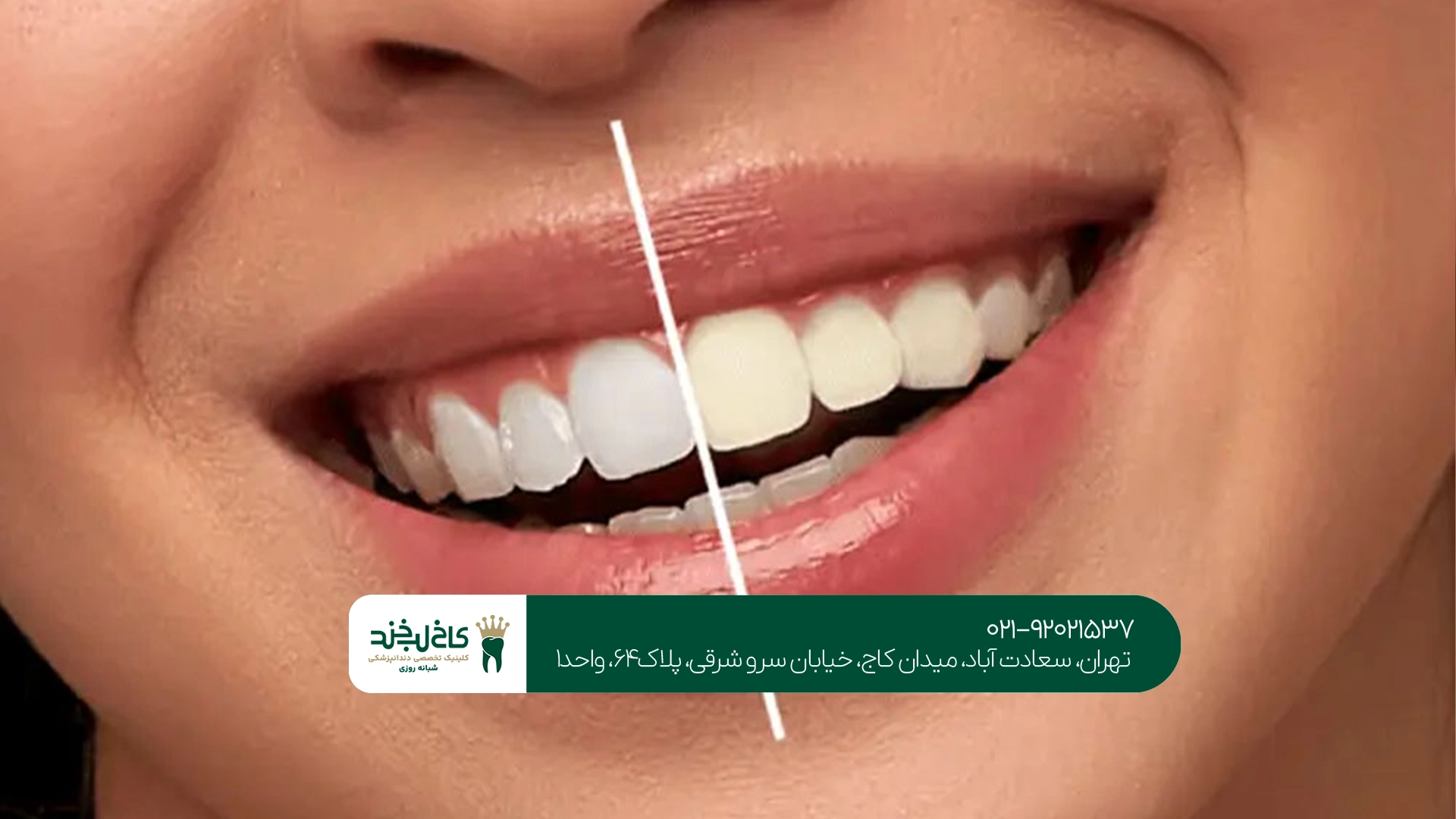 تفاوت سفید کردن دندان در خانه و کلینیک