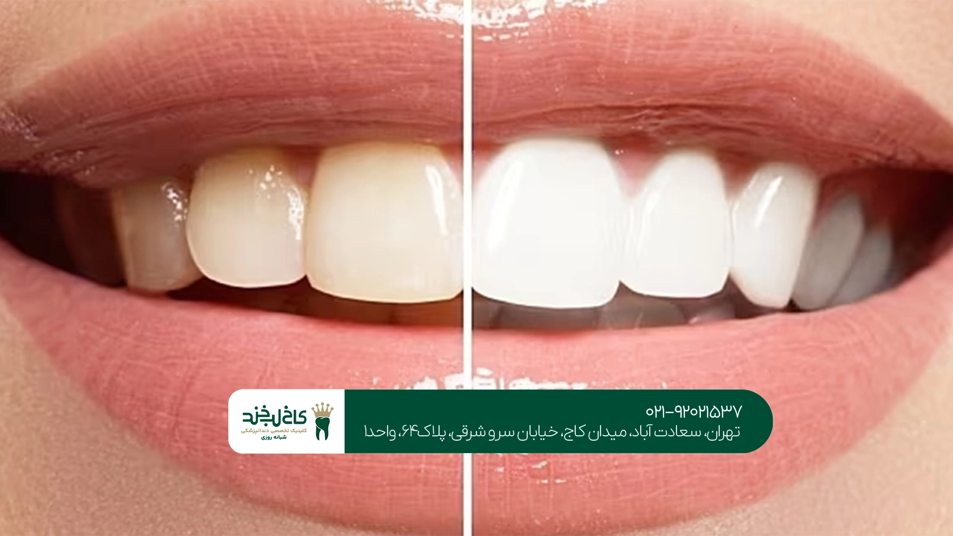 مزایا و معایب سفید کردن دندان در کلینیک