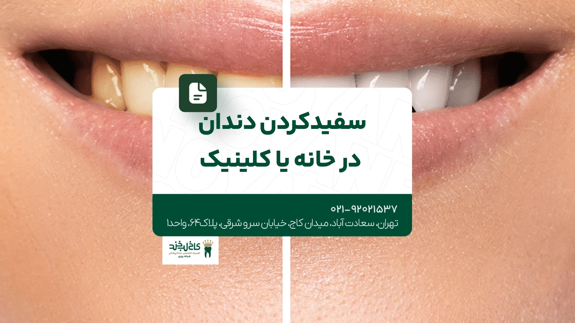 سفید کردن دندان در خانه یا کلینیک