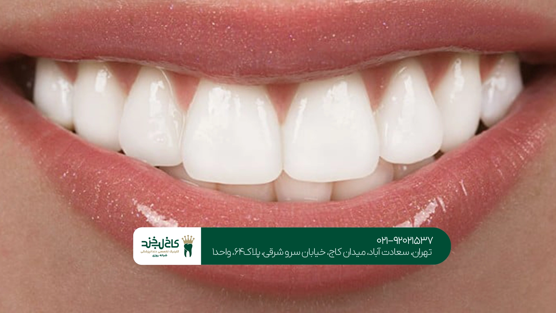متخصص طراحی لبخند در تهران
