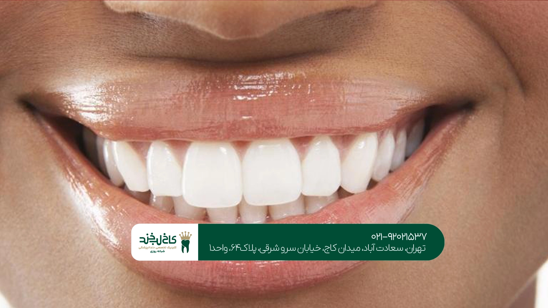 ماندگاری طراحی لبخند چقدر است؟