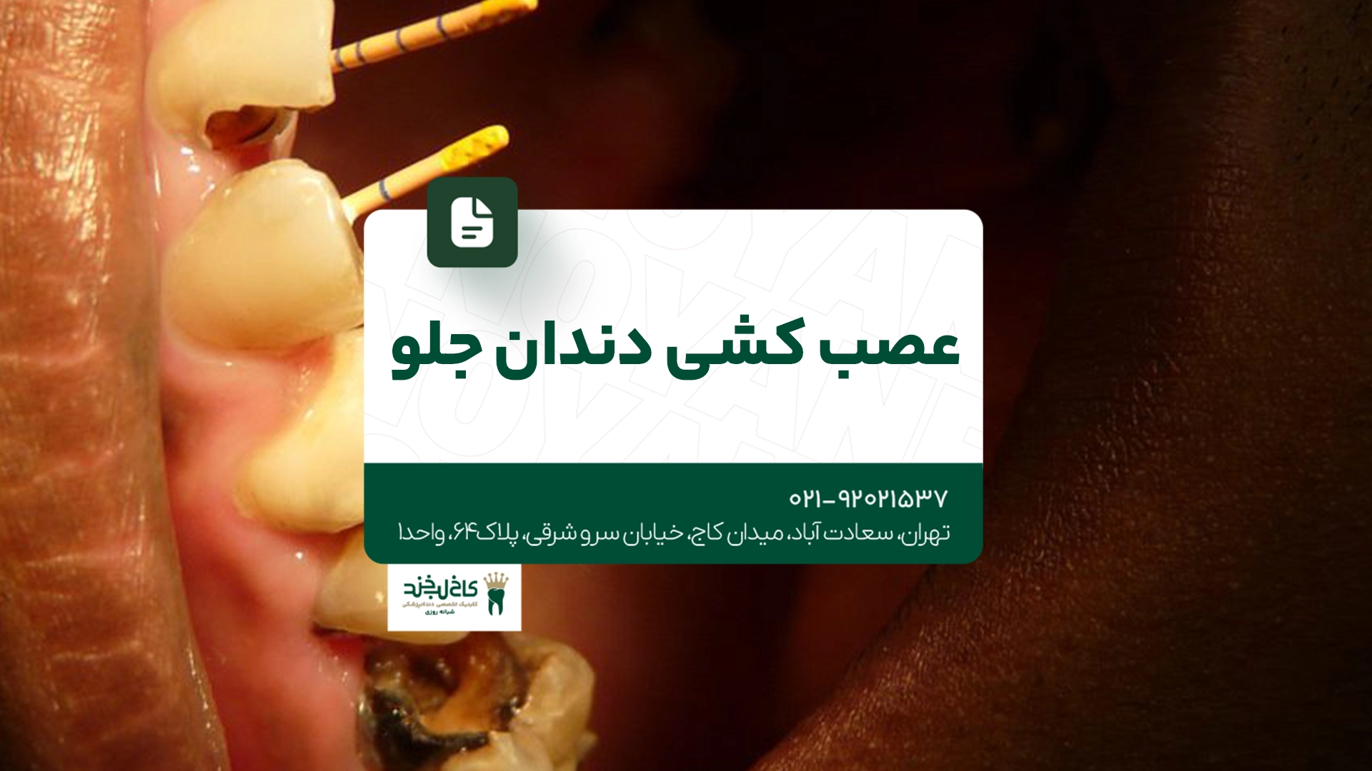 عصب کشی دندان جلو