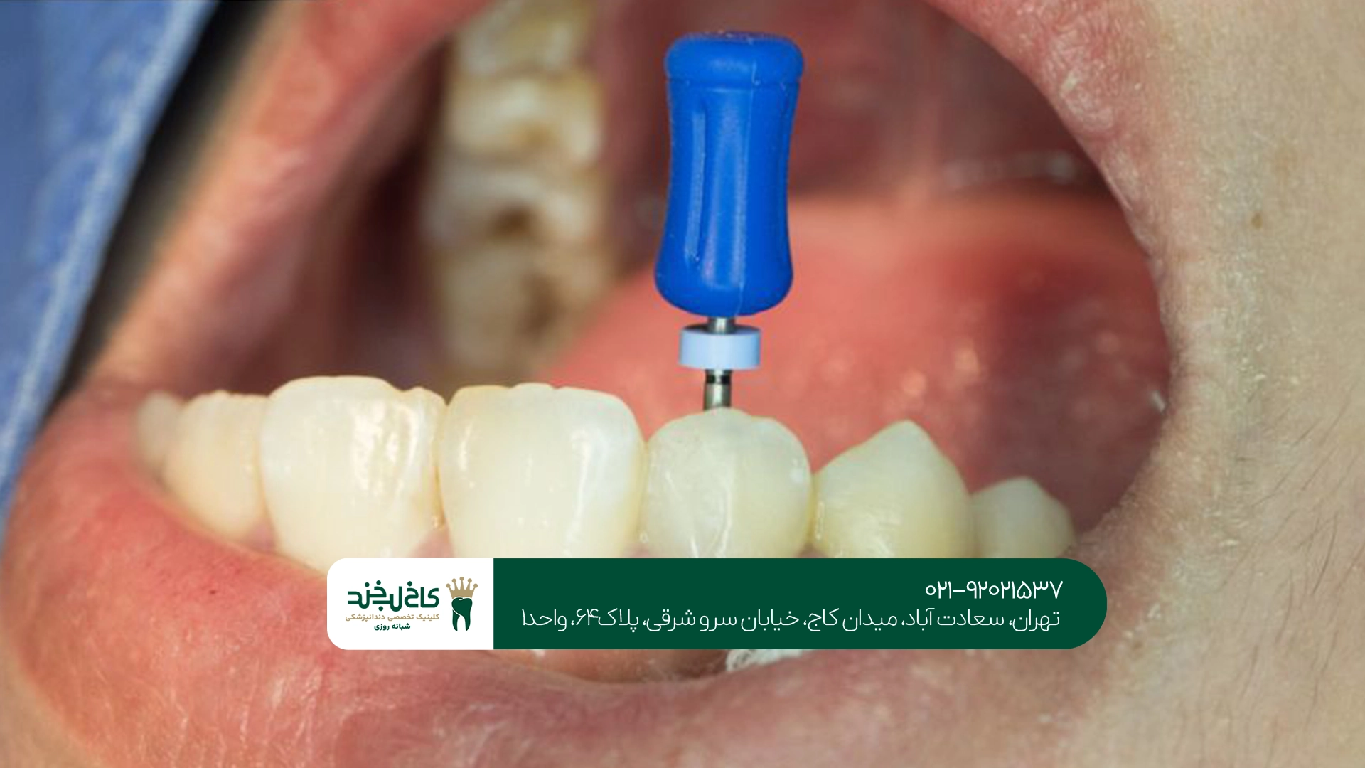 بهترین دکتر عصب کشی دندان جلو