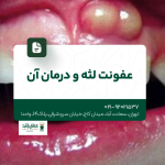 عفونت لثه و درمان آن