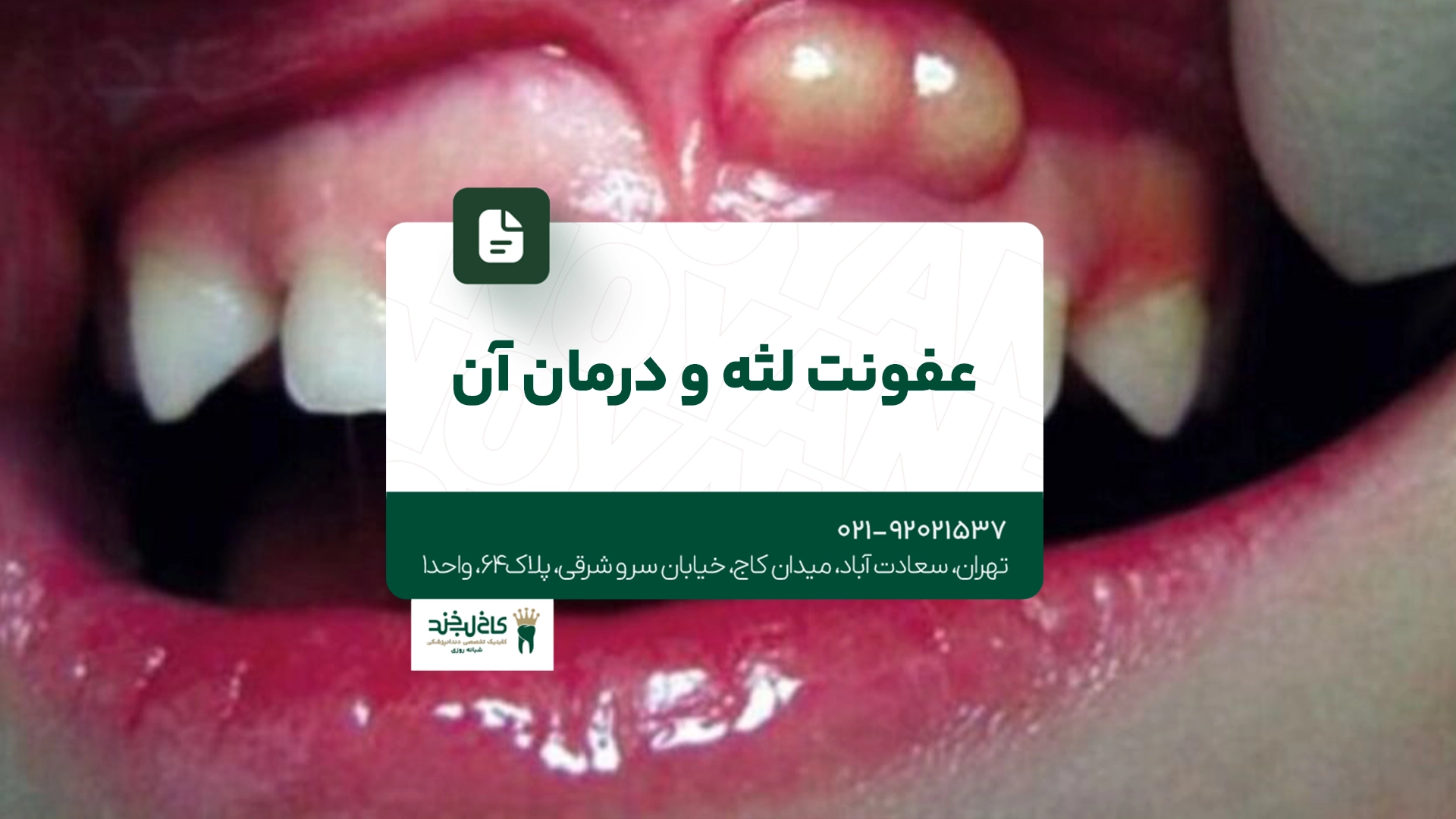 عفونت لثه و درمان آن عفونت لثه و درمان آن