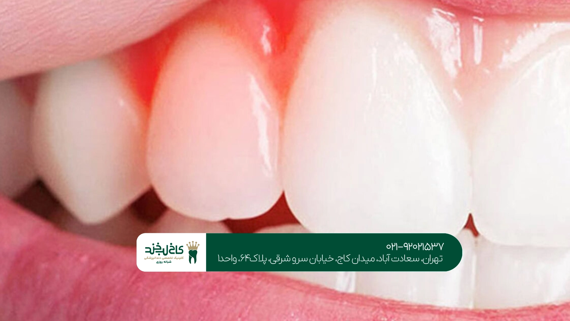 درمان عفونت لثه درمان عفونت لثه