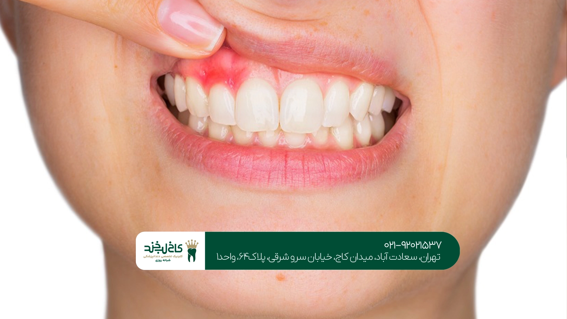 درمان عفونت لثه در تهران درمان عفونت لثه در تهران