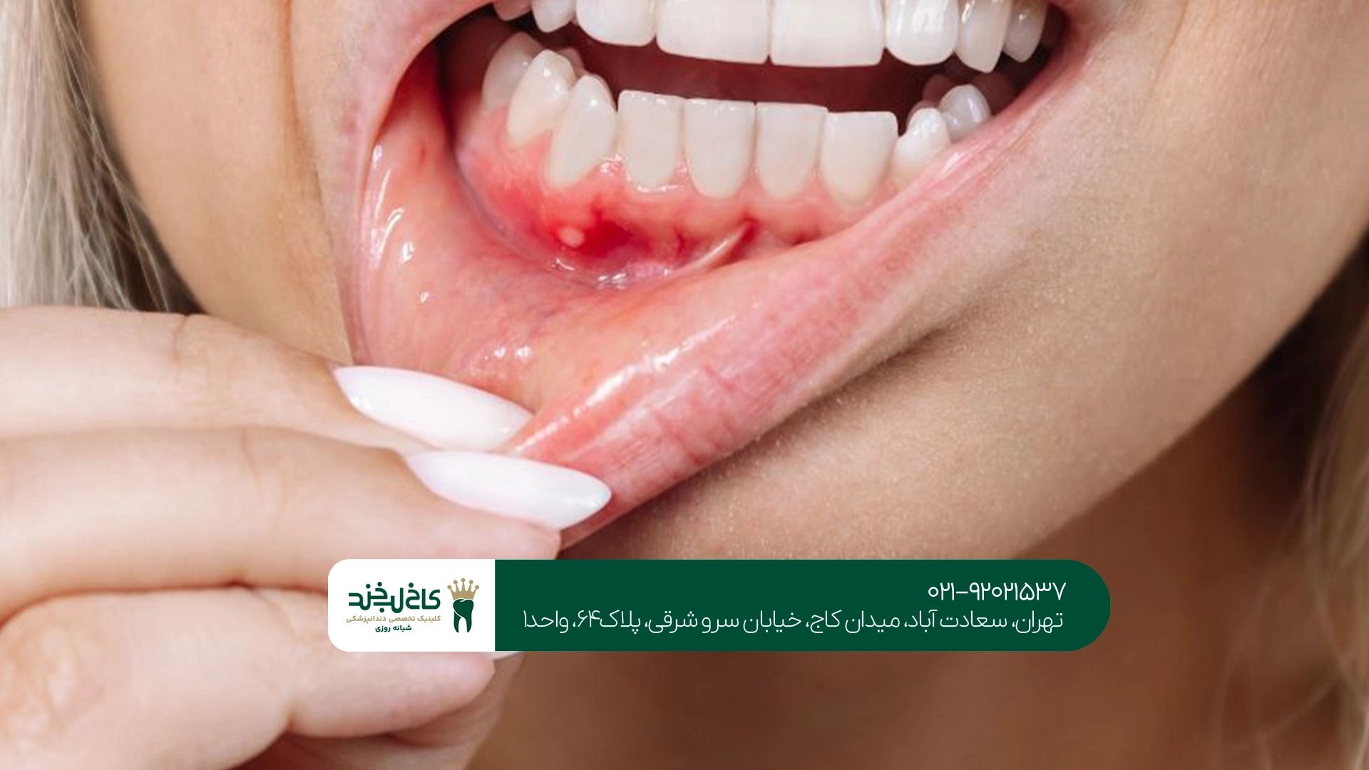 بهترین متخصص درمان عفونت لثه بهترین متخصص درمان عفونت لثه
