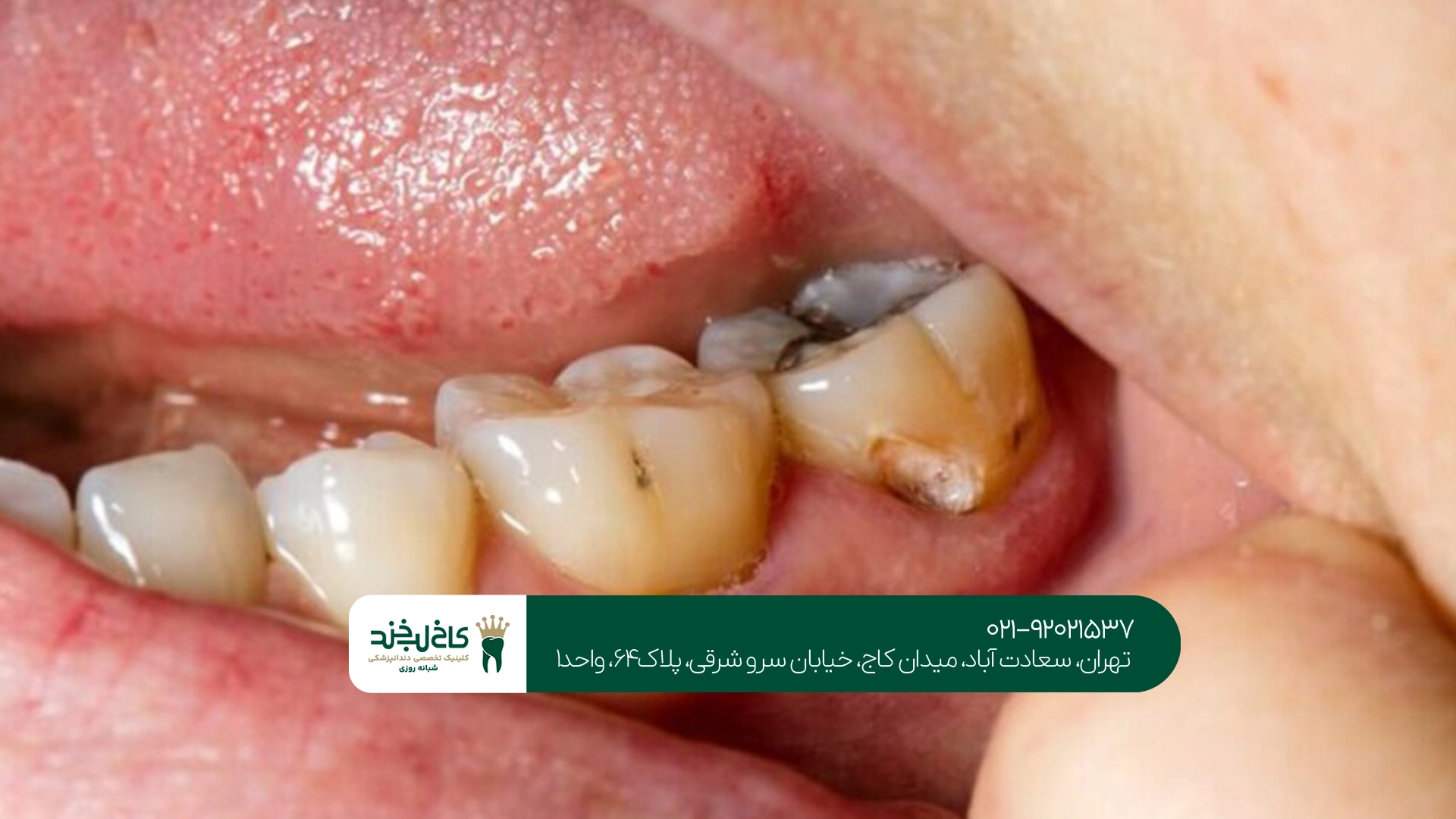 مهمترین نشانههای عفونت ایمپلنت بعد از جراحی