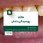 علائم پوسیدگی دندان