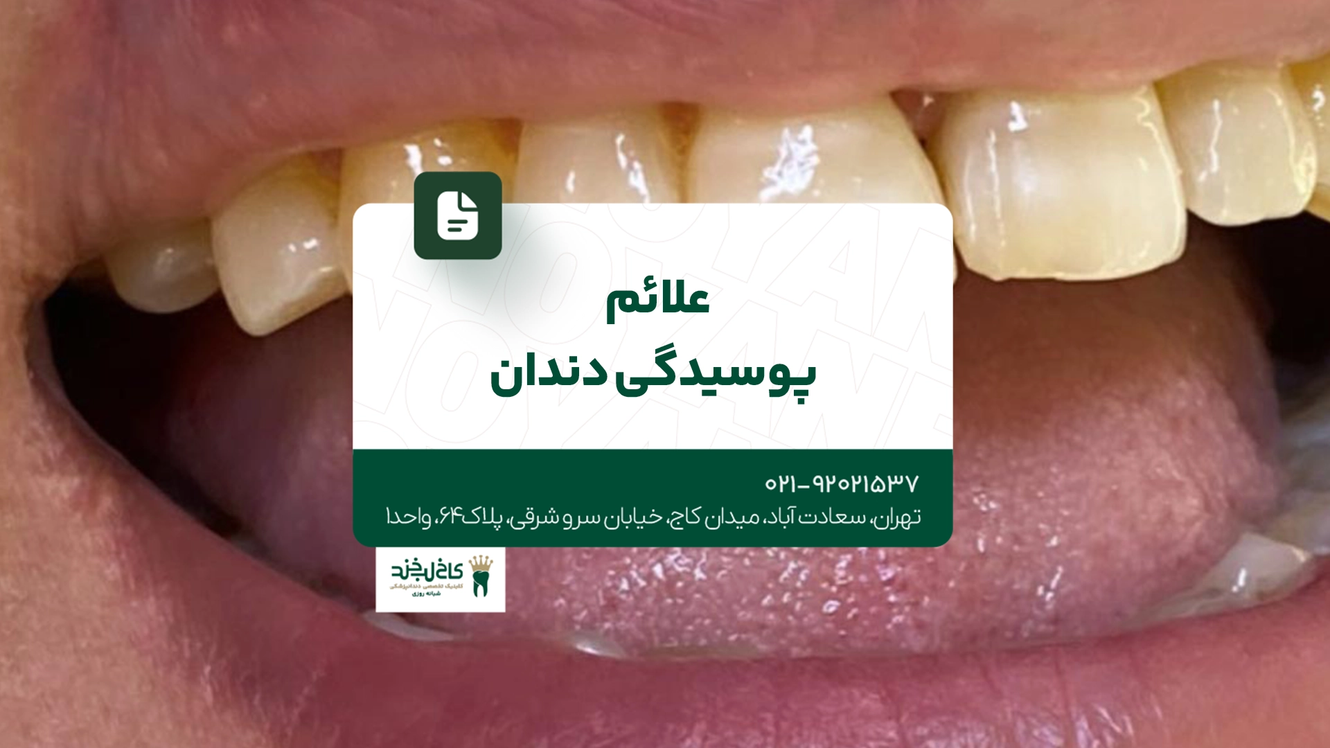 علائم پوسیدگی دندان