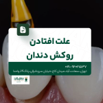 علت افتادن روکش دندان