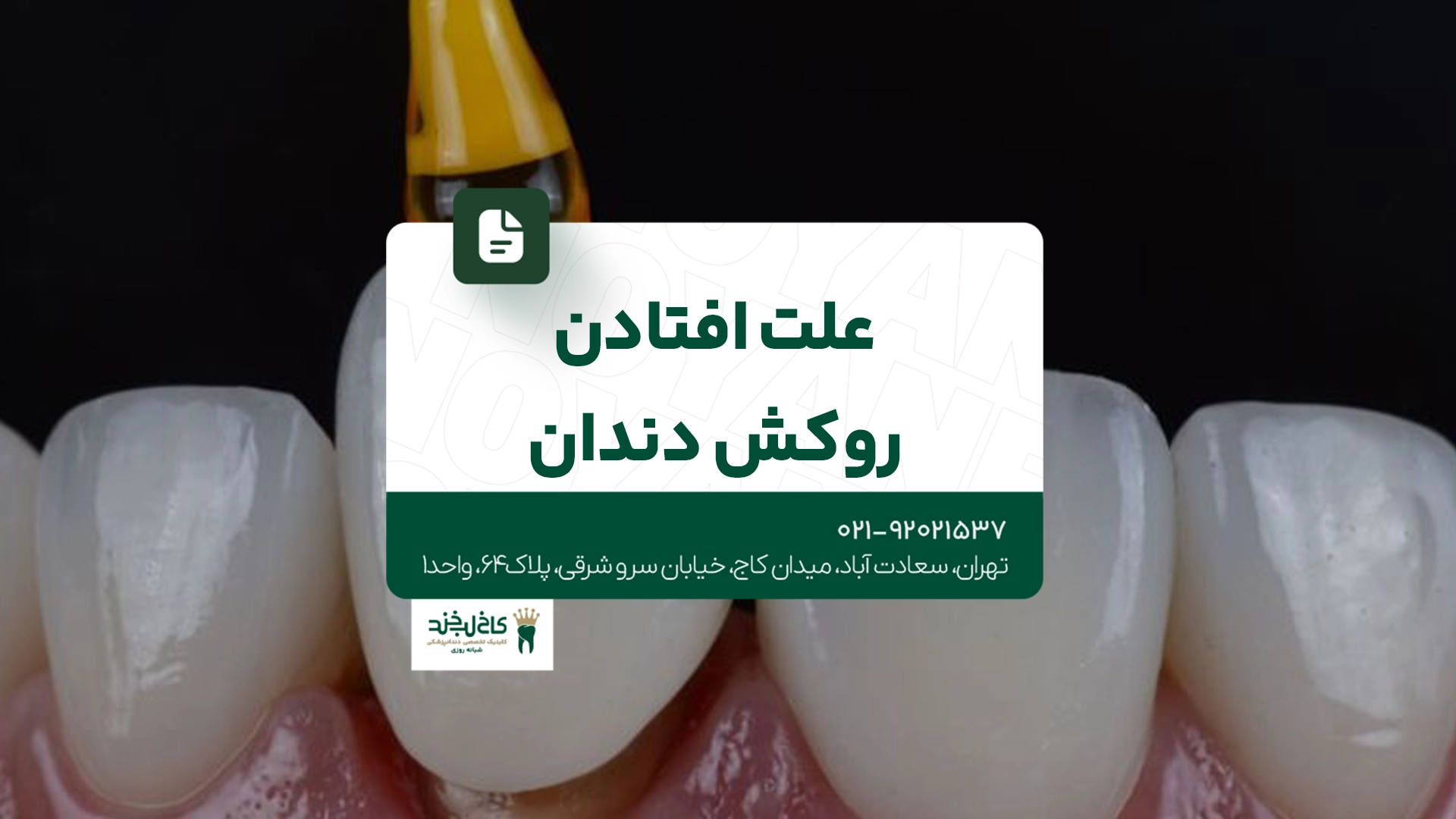 علت افتادن روکش دندان