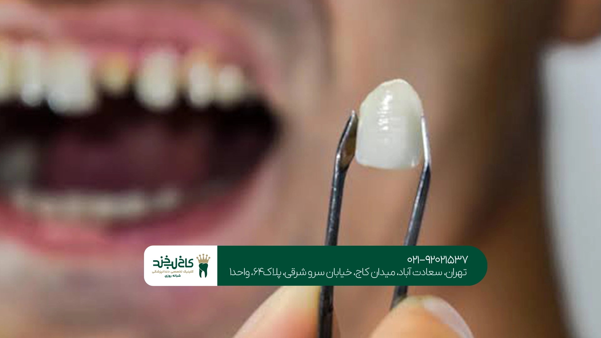 ترمیم روکش دندان با بهترین کیفیت