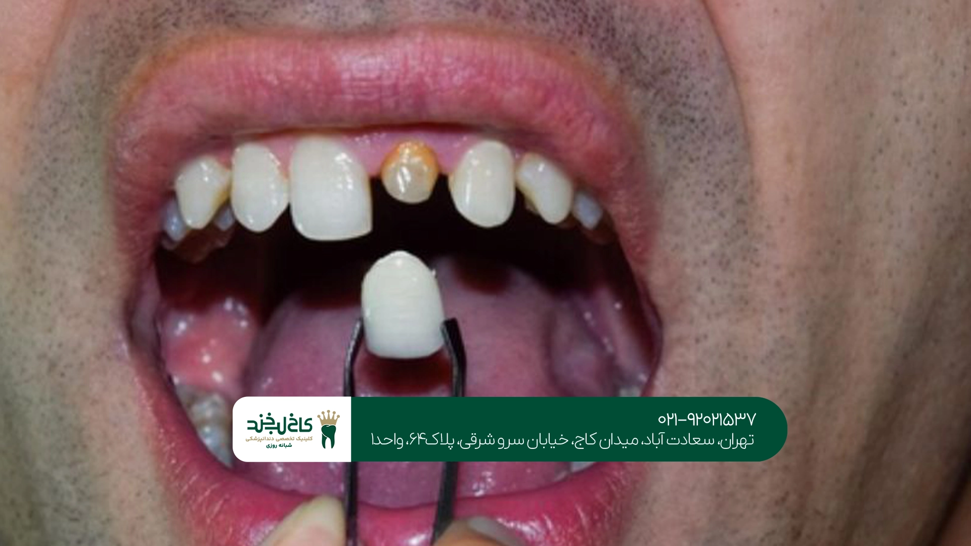 چه زمانی برای افتادن روکش دندان باید به دندانپزشک مراجعه کرد؟