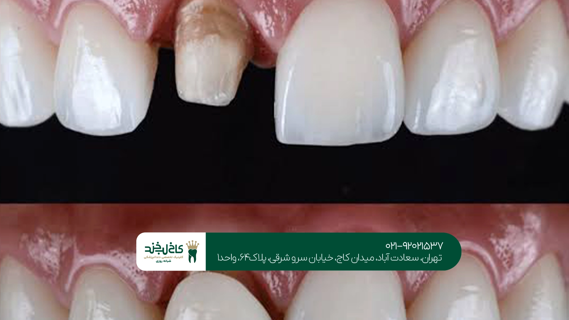 مهمترین دلایل شل شدن و افتادن روکش دندان