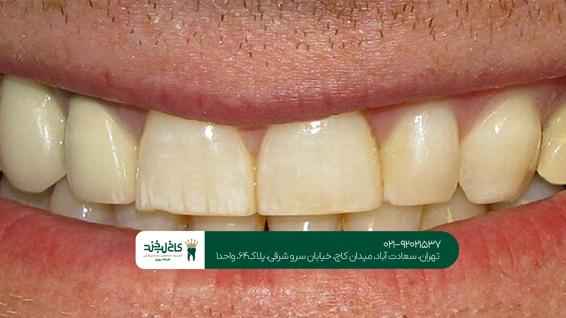 درمان زردی دندان