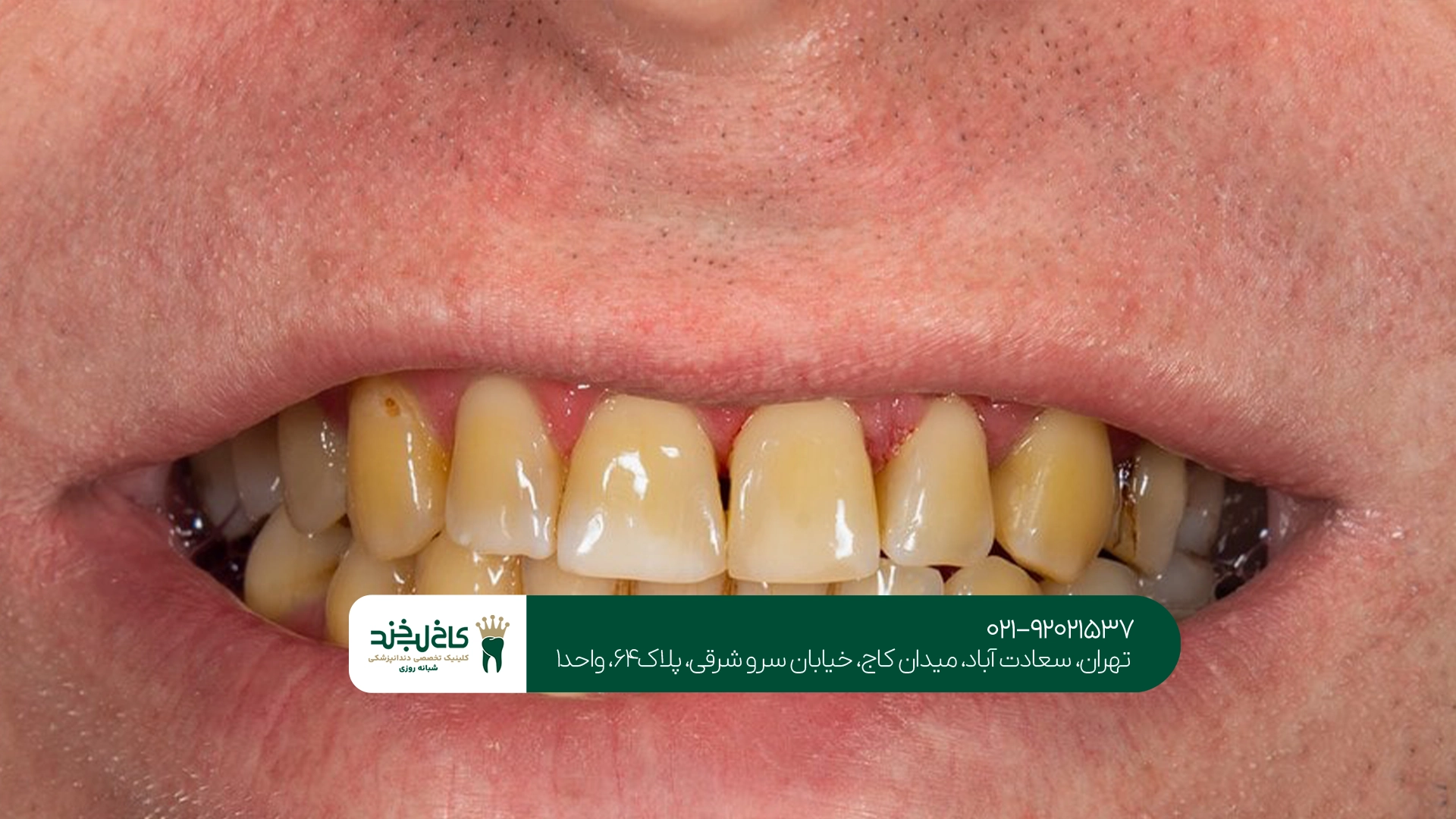 چگونه میتوان از تغییر رنگ دندان جلوگیری کرد؟