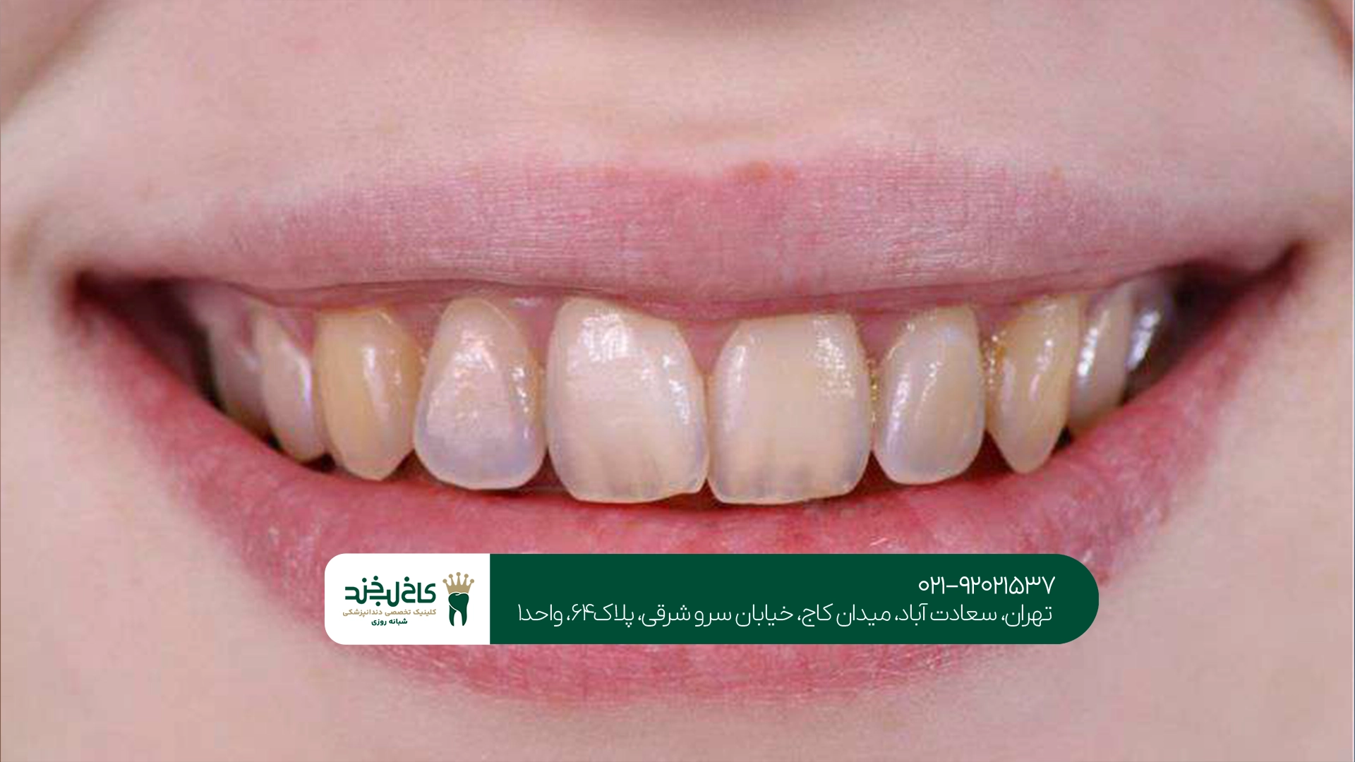 تفاوت تغییر رنگ داخلی و خارجی دندان