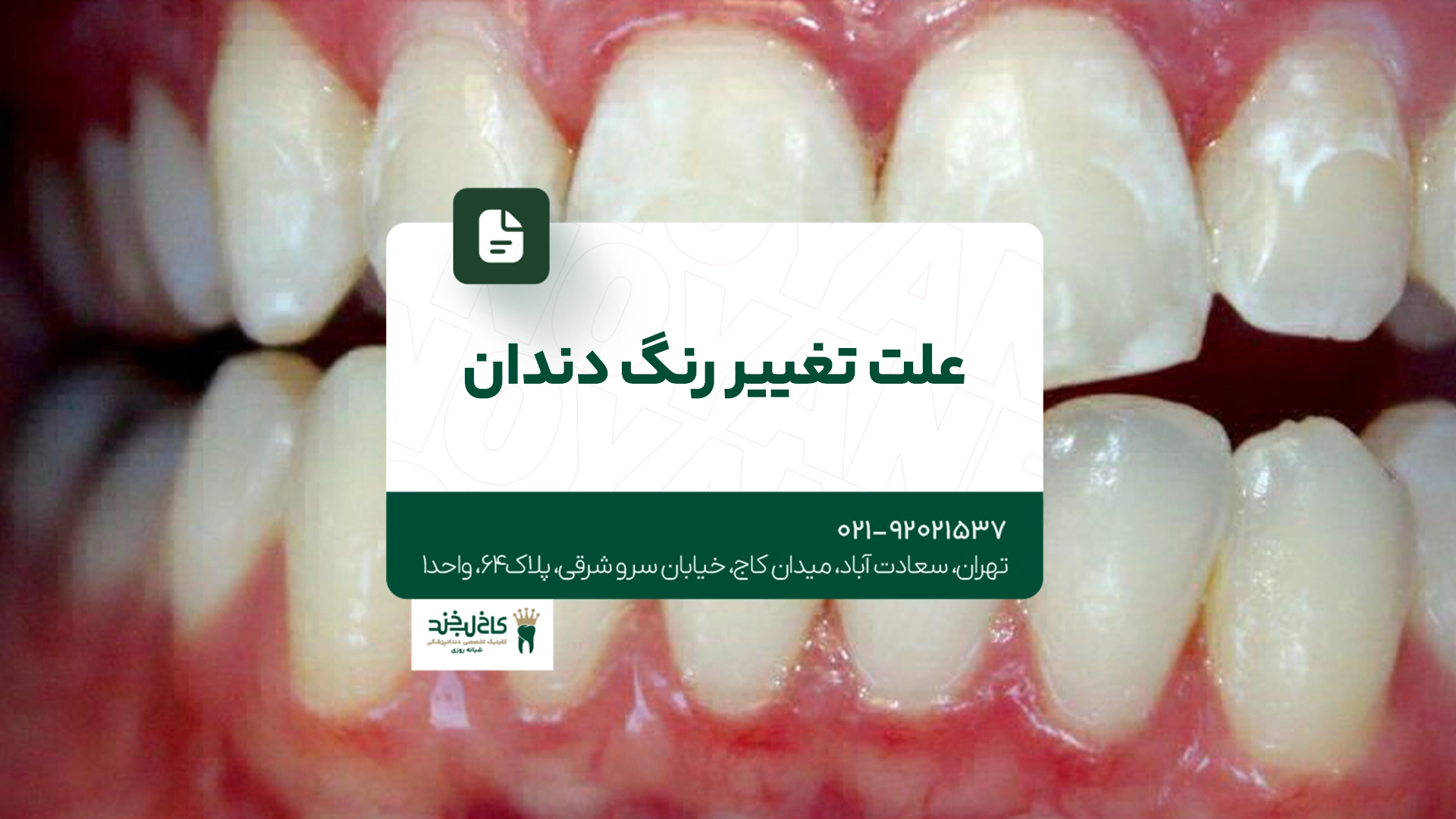 علت تغییر رنگ دندان