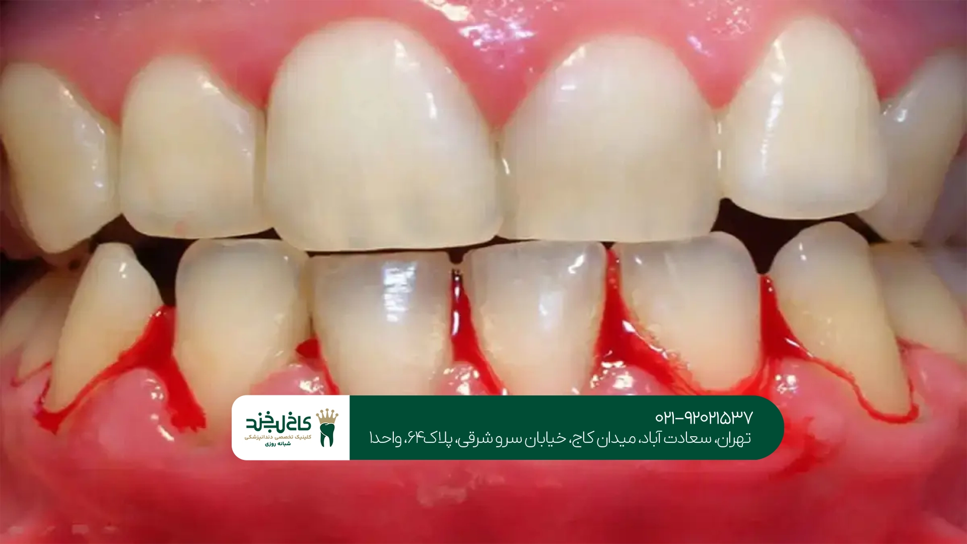 درمان تخصصی خونریزی لثه