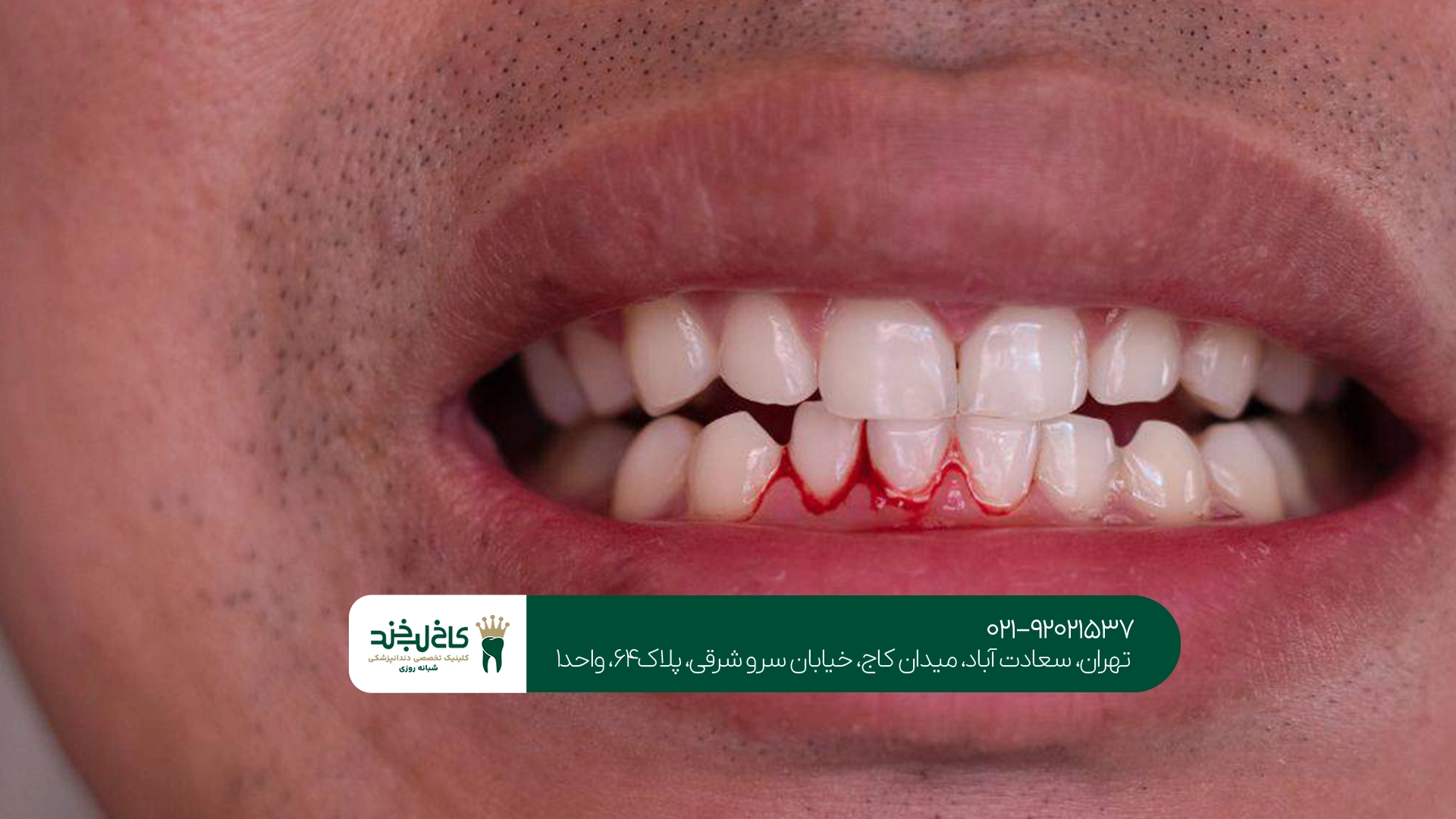 آیا خونریزی لثه نشانه بیماری است؟