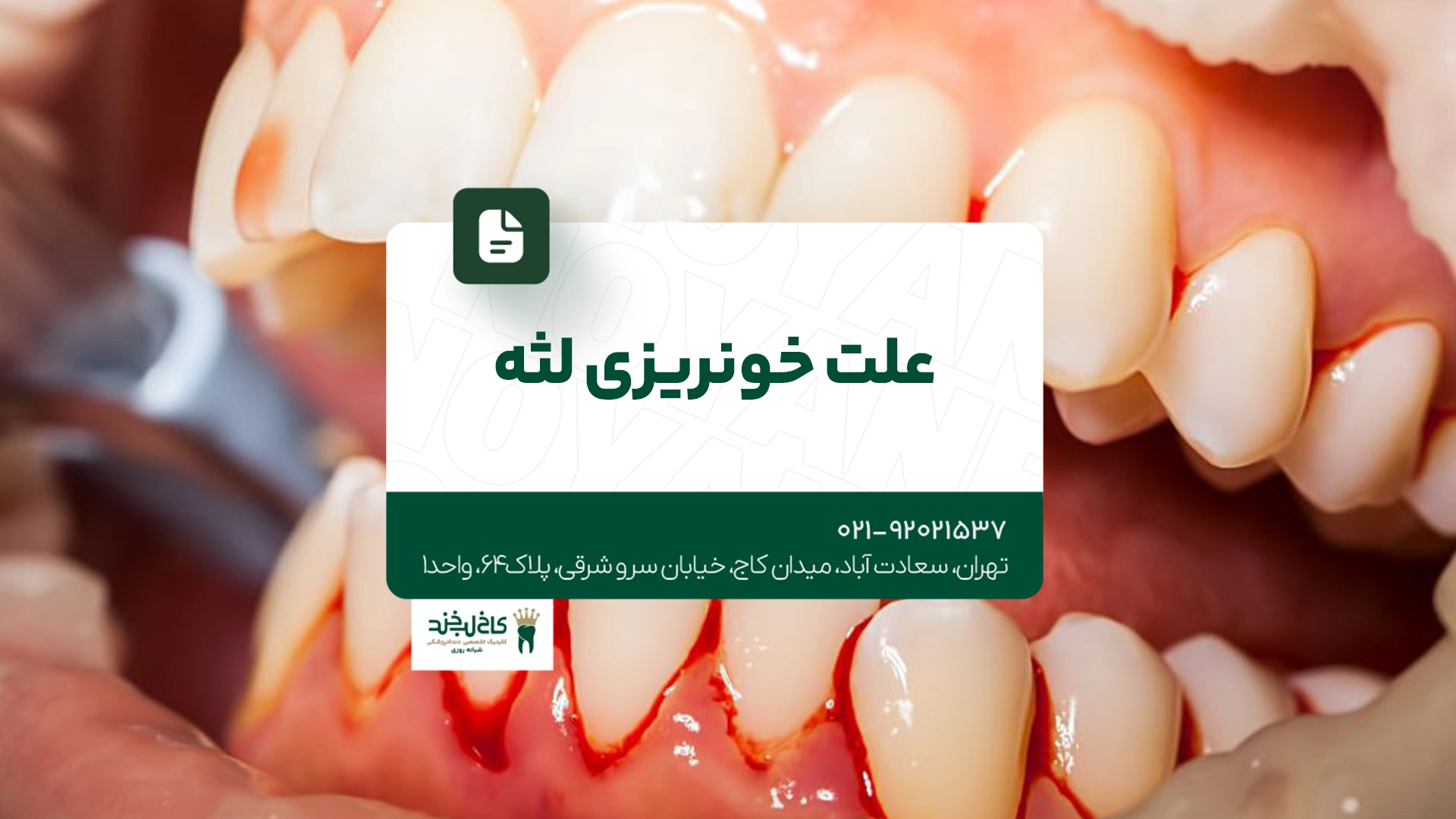 علت خونریزی لثه
