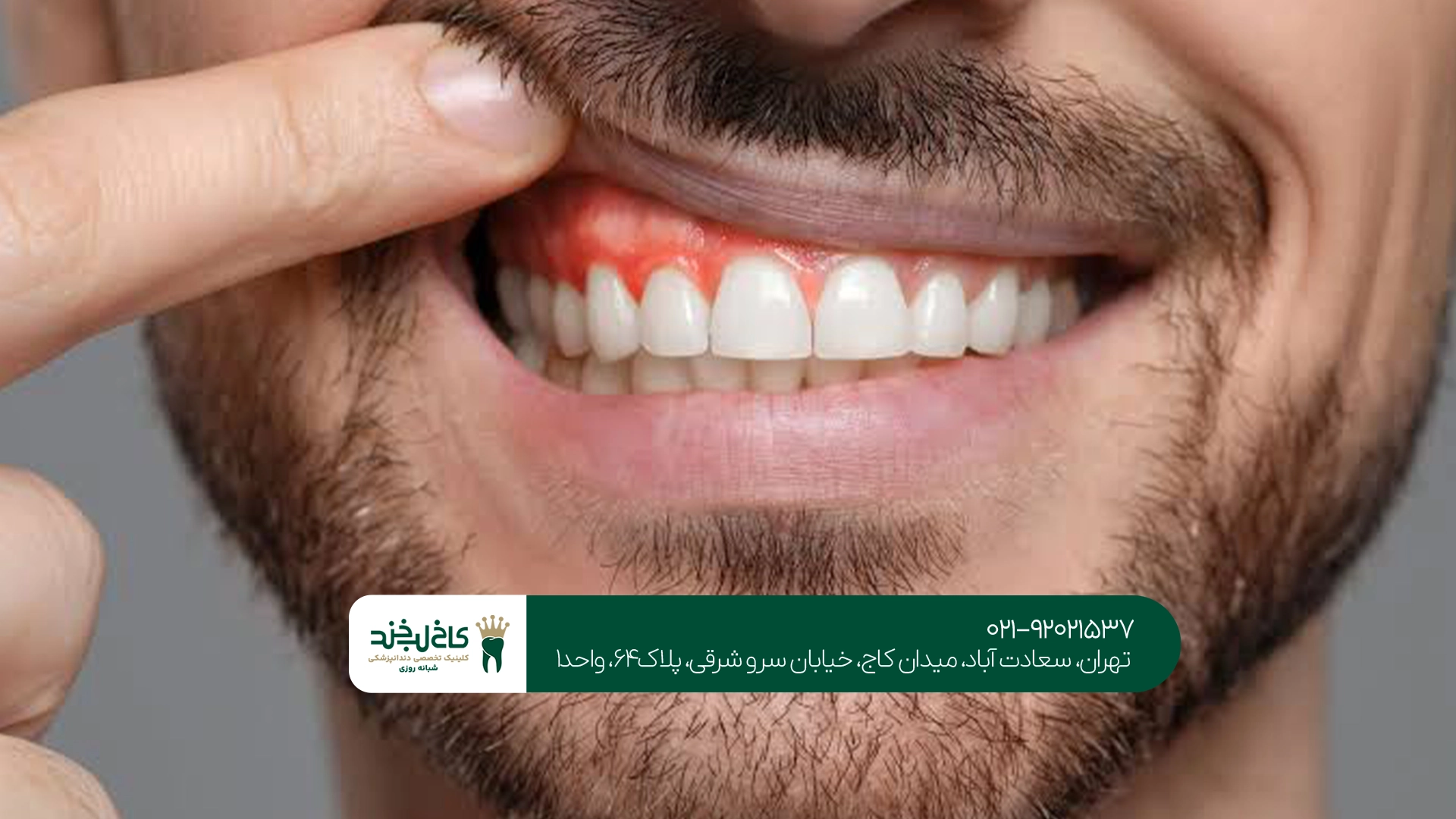 چگونه از درد و التهاب لثه پیشگیری کنیم؟
