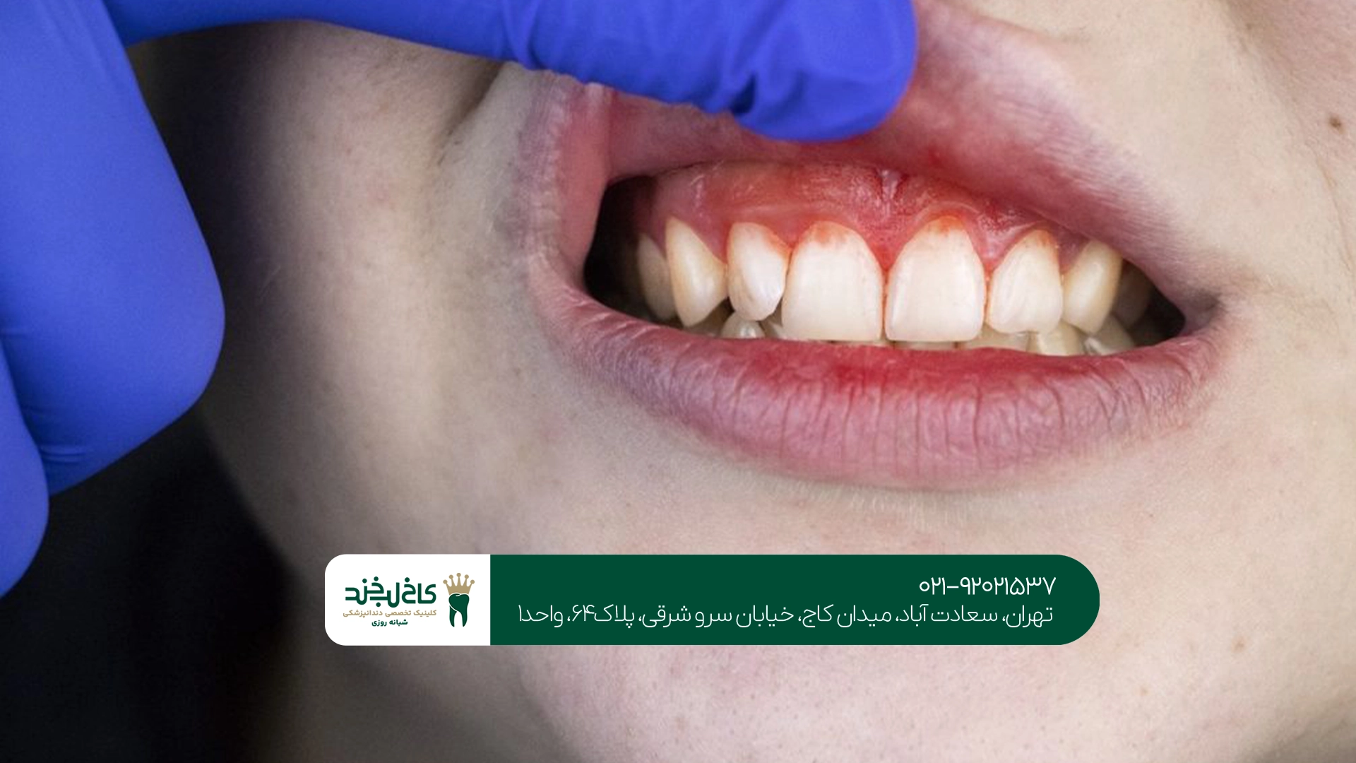 چگونه درد لثه را در خانه کاهش دهیم؟