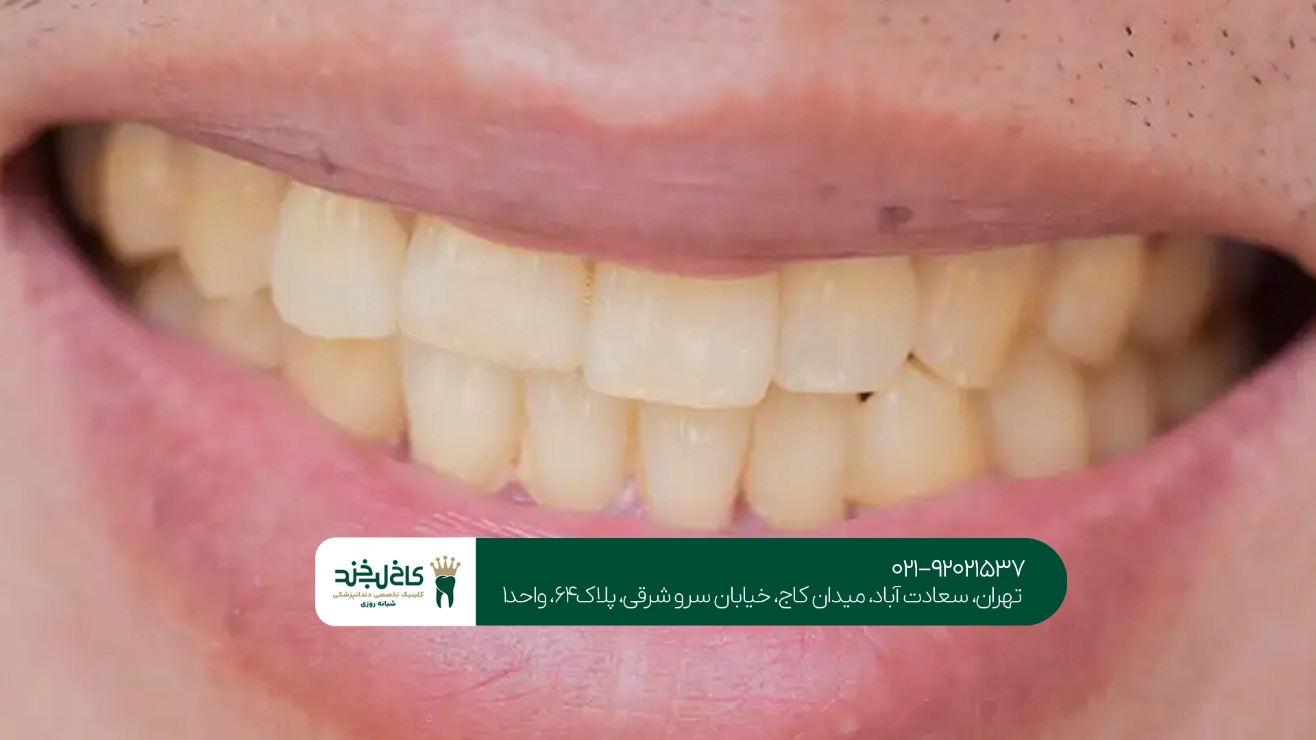بهترین کلینیک سفید کردن دندان