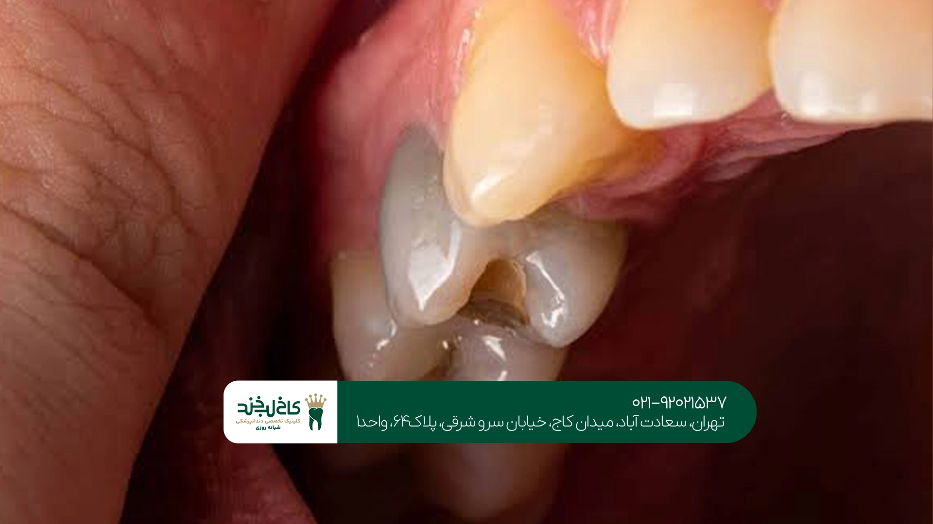 چگونه از سیاه شدن دندان جلوگیری کنیم؟