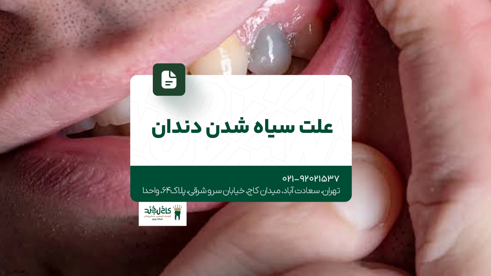 علت سیاه شدن دندان